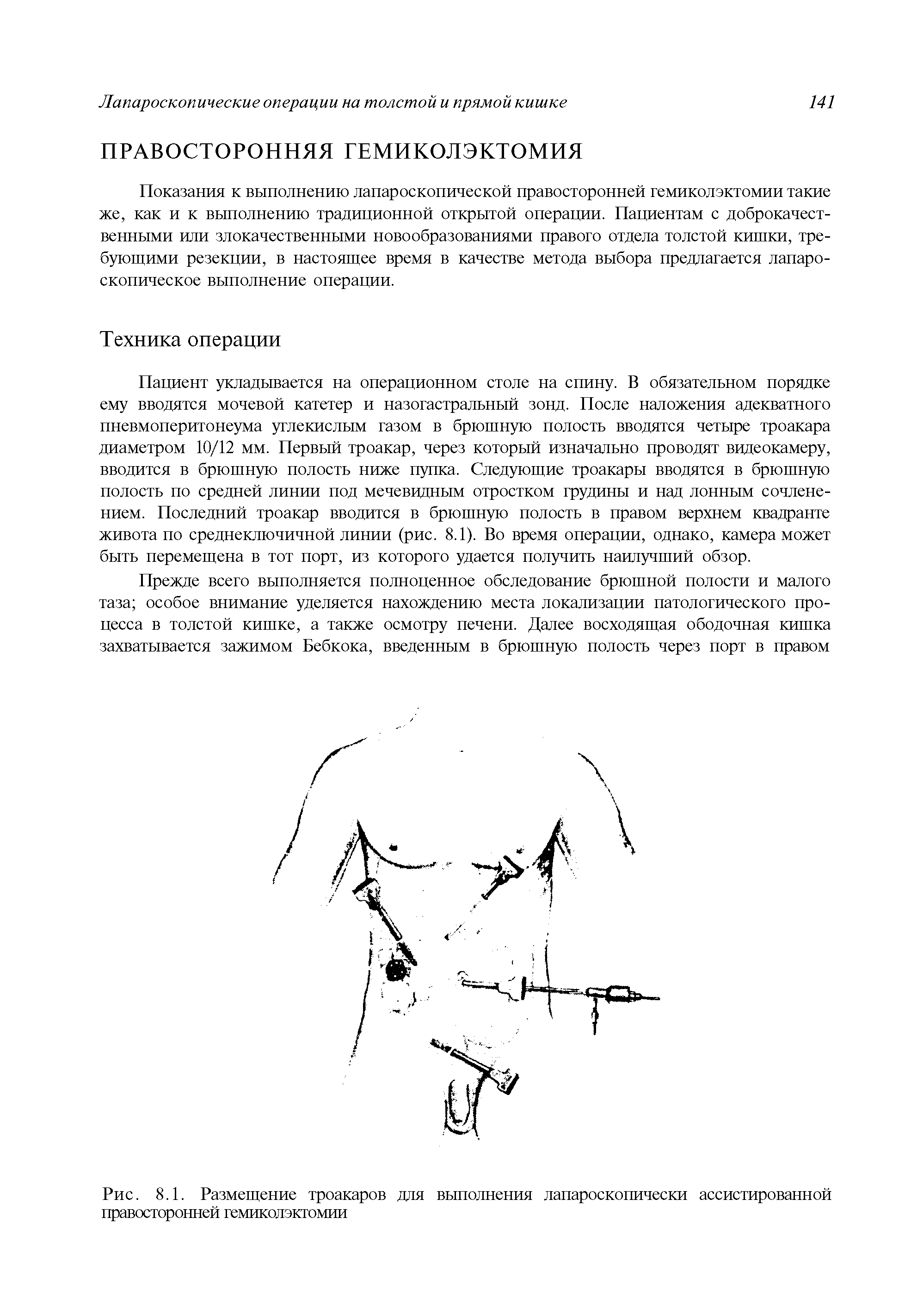 Рис. 8.1. Размещение троакаров для выполнения лапароскопически ассистированной правосторонней гемиколэктомии...