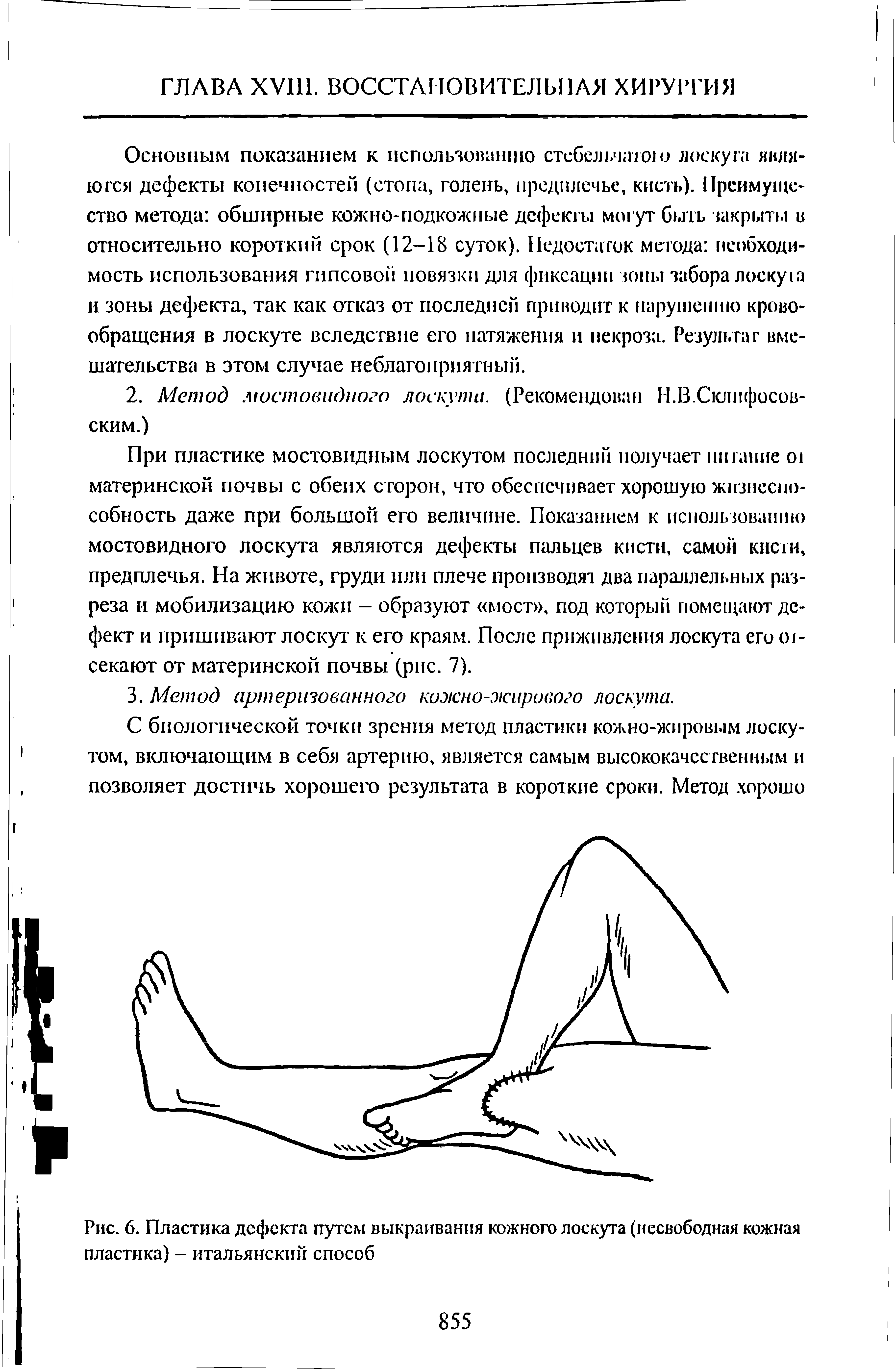 Рис. 6. Пластика дефекта путем выкраивания кожного лоскута (несвободная кожная пластика) - итальянский способ...