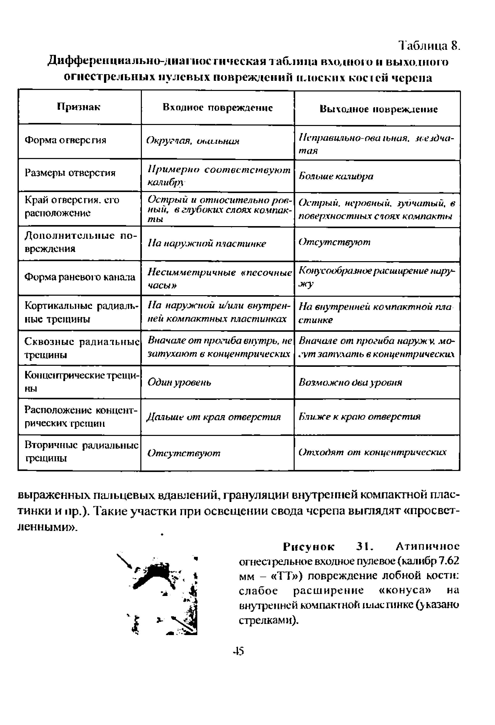 Рисунок 31. Атипичное огнестрельное входное пулевое (калибр 7.62 мм - ТТ ) повреждение лобной кости слабое расширение конуса на внугренней компактной нлаепшке (указано стрелками).