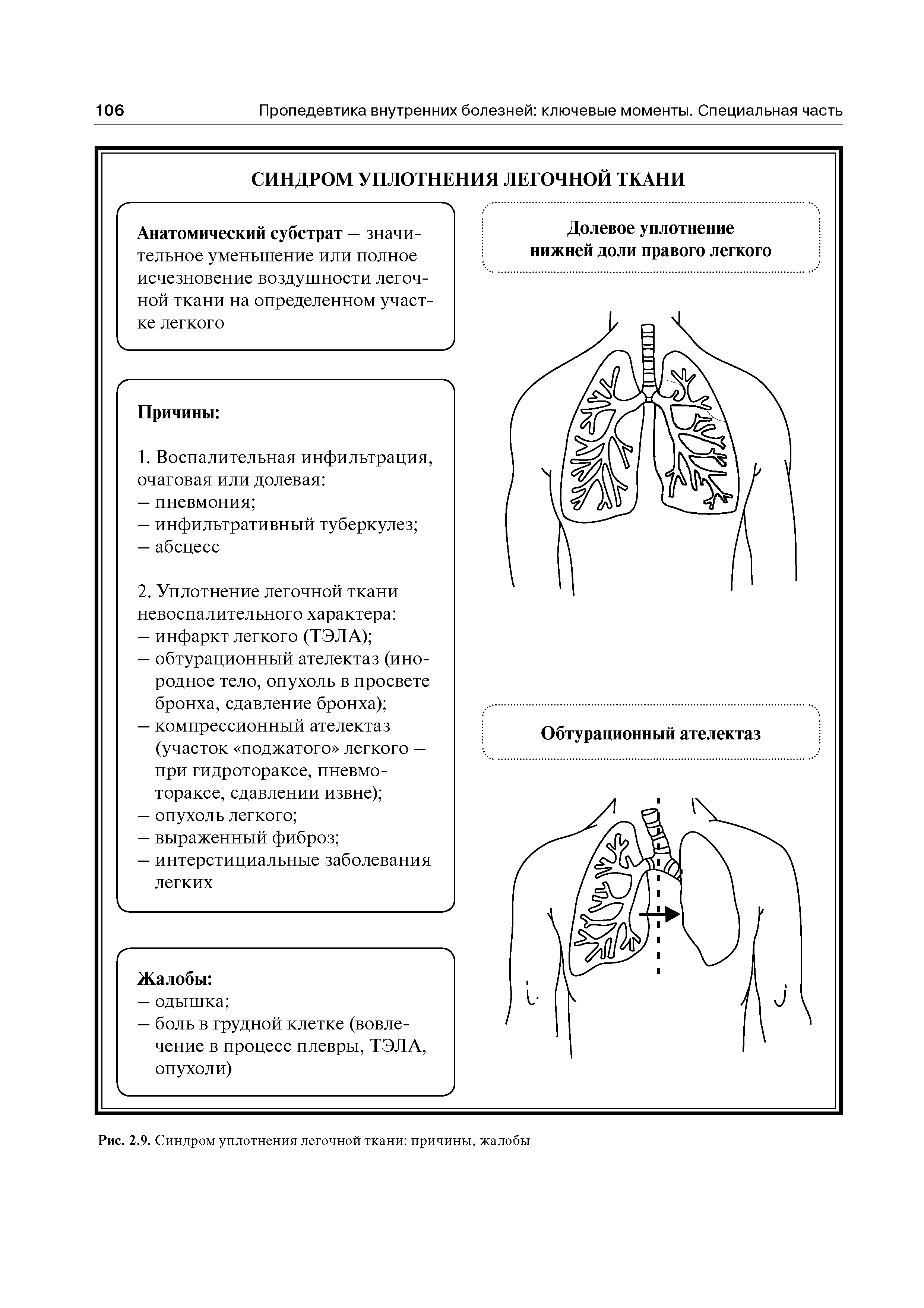 Рис. 2.9. Синдром уплотнения легочной ткани причины, жалобы...