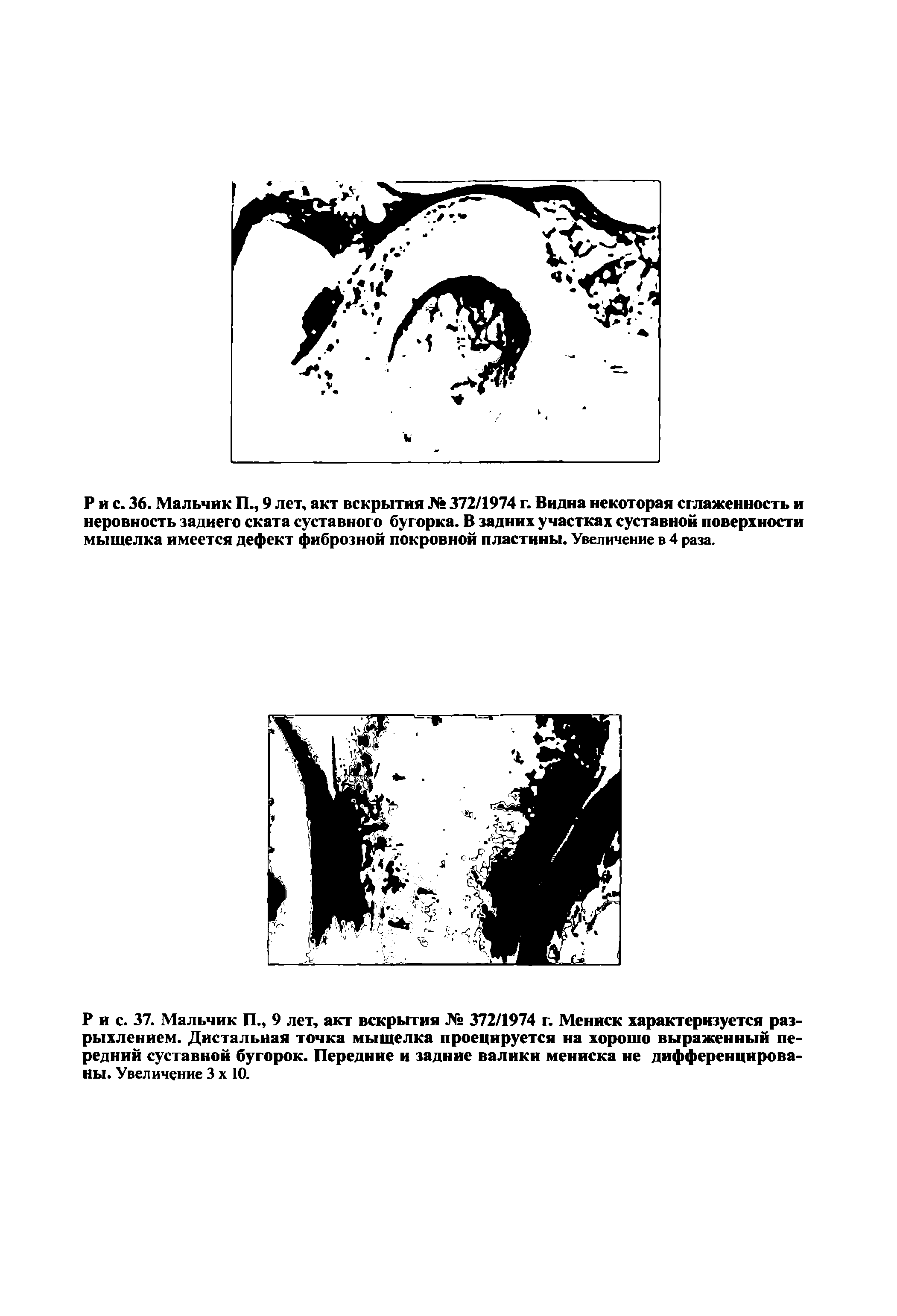 Рис. 37. Мальчик П., 9 лет, акт вскрытия № 372/1974 г. Мениск характеризуется разрыхлением. Дистальная точка мыщелка проецируется на хорошо выраженный передний суставной бугорок. Передние и задние валики мениска не дифференцированы. Увеличение 3 х 10.