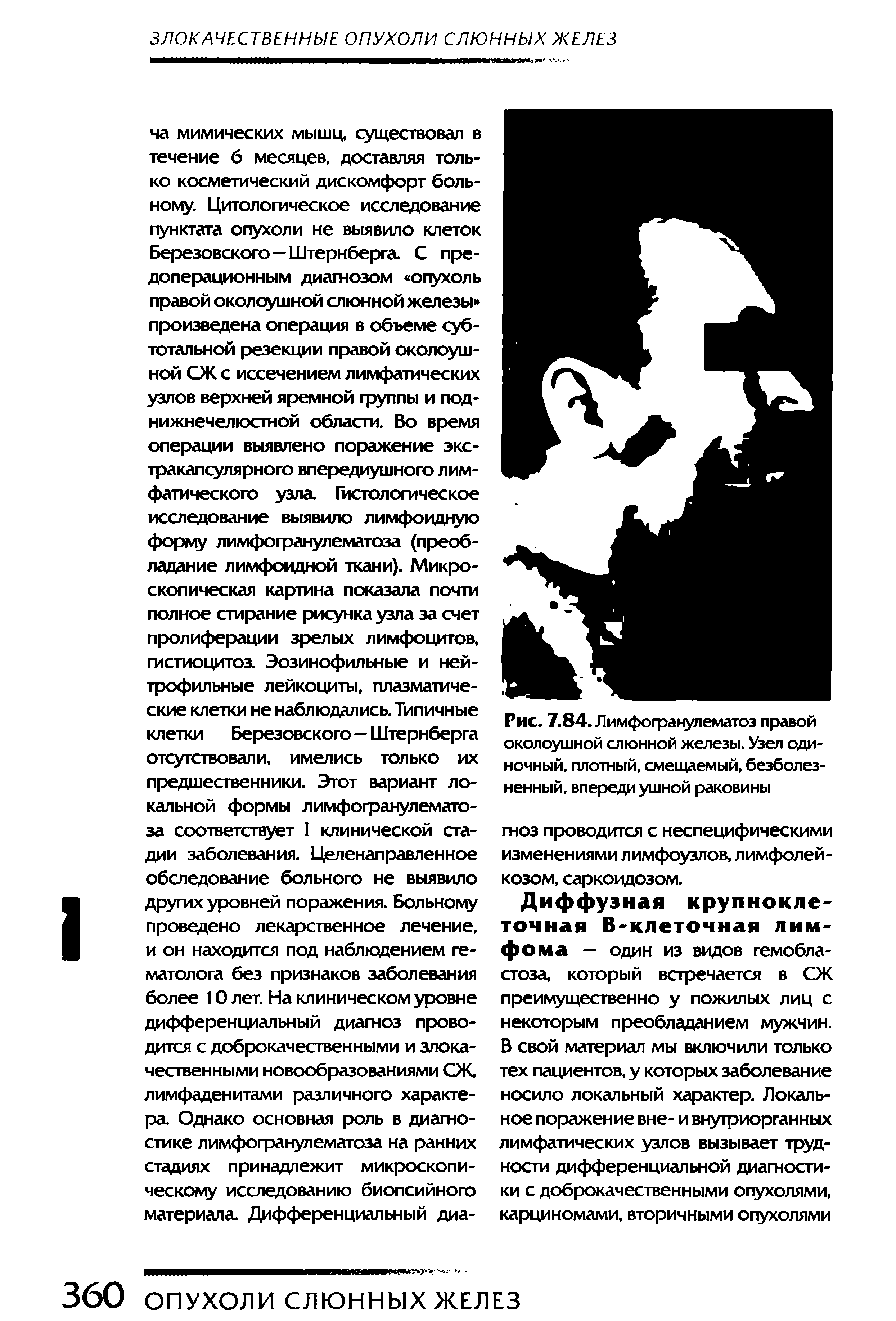 Рис. 7.84. Лимфогранулематоз правой околоушной слюнной железы. Узел одиночный, плотный, смещаемый, безболезненный, впереди ушной раковины гноз проводится с неспецифическими изменениями лимфоузлов, лимфолей-козом, саркоидозом.