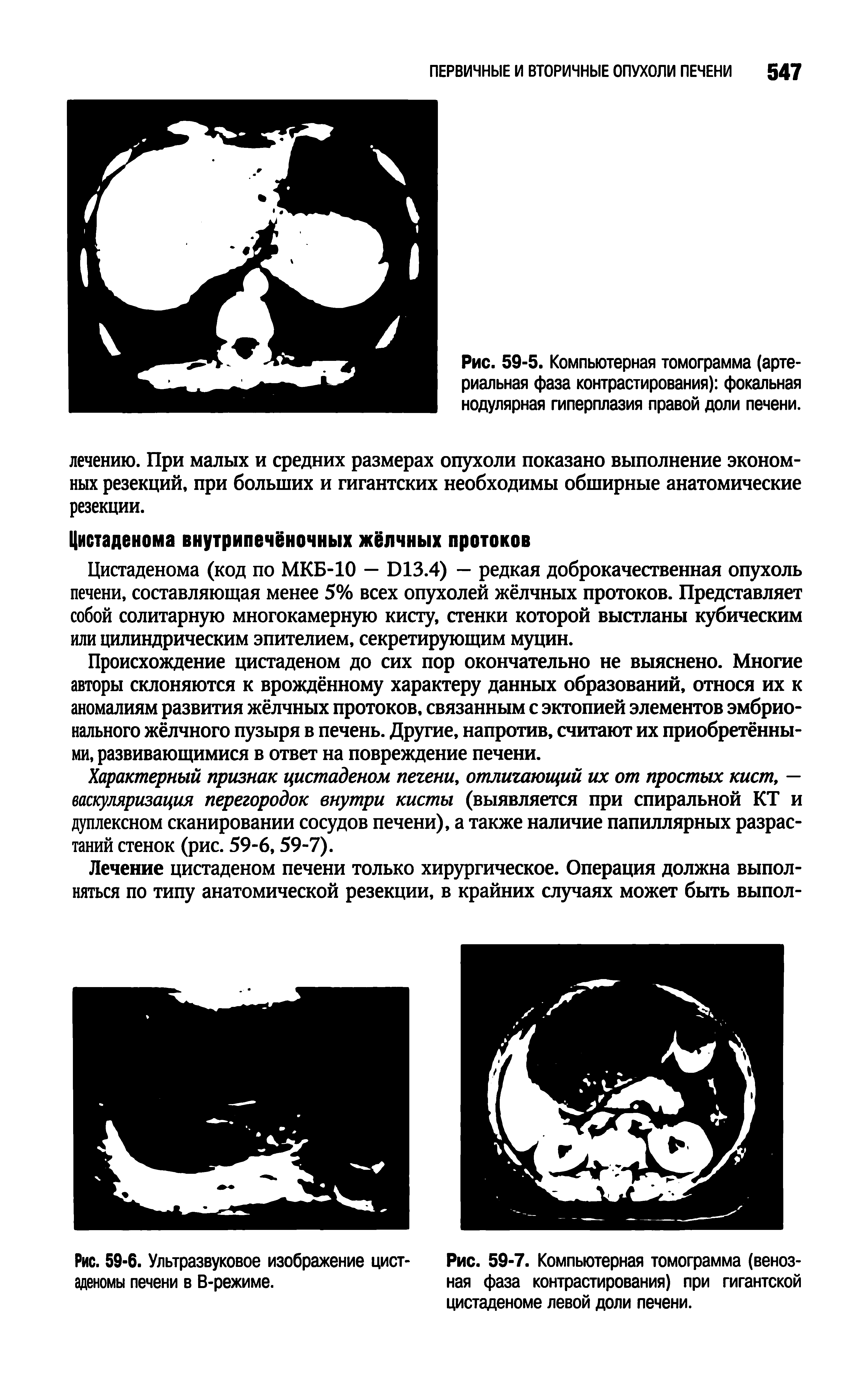 Рис. 59-5. Компьютерная томограмма (артериальная фаза контрастирования) фокальная нодулярная гиперплазия правой доли печени.