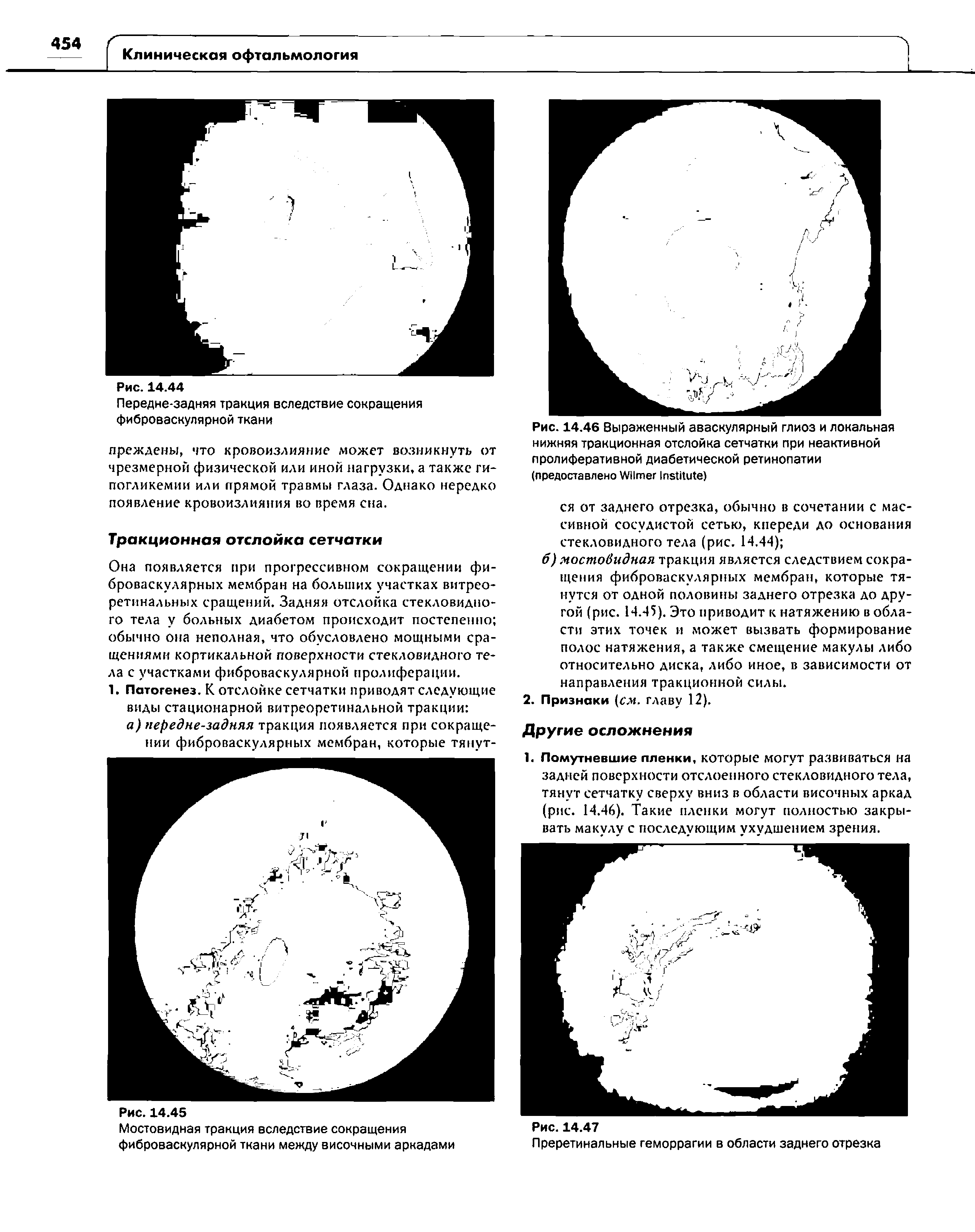 Рис. 14.46 Выраженный аваскулярный глиоз и локальная нижняя тракционная отслойка сетчатки при неактивной пролиферативной диабетической ретинопатии (предоставлено W I )...