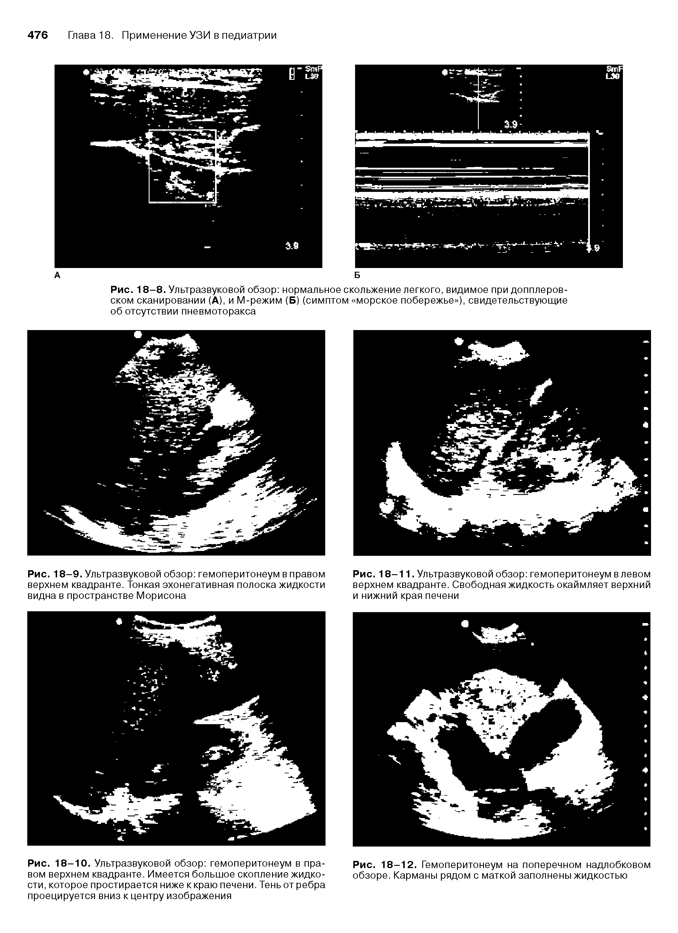 Рис. 18-8. Ультразвуковой обзор нормальное скольжение легкого, видимое при допплеровском сканировании (А), и М-режим (Б) (симптом морское побережье ), свидетельствующие об отсутствии пневмоторакса...