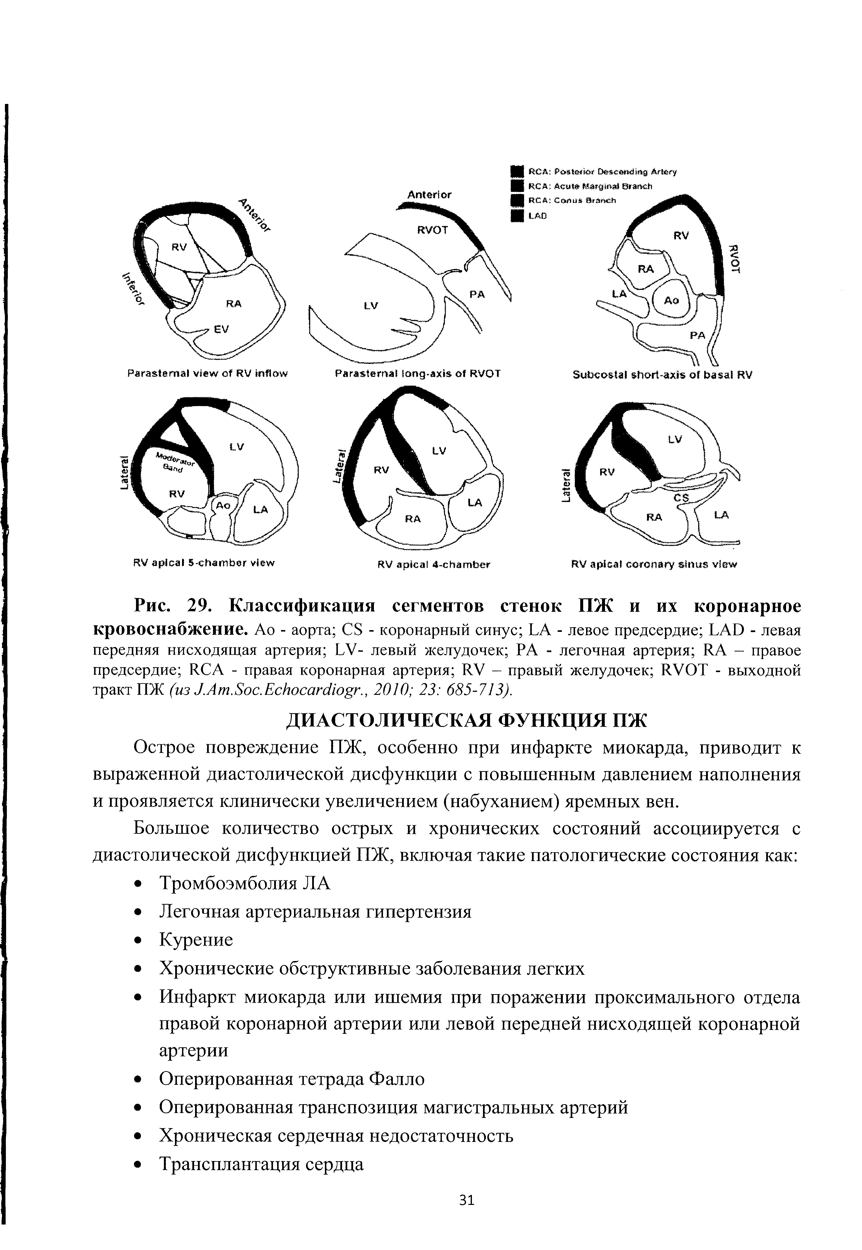 Рис. 29. Классификация сегментов стенок ПЖ и их коронарное кровоснабжение. Ао - аорта CS - коронарный синус LA - левое предсердие LAD - левая передняя нисходящая артерия LV- левый желудочек РА - легочная артерия RA - правое предсердие RCA - правая коронарная артерия RV - правый желудочек RVOT - выходной тракт ПЖ (из J.A .S .E ., 2010 23 685-713).