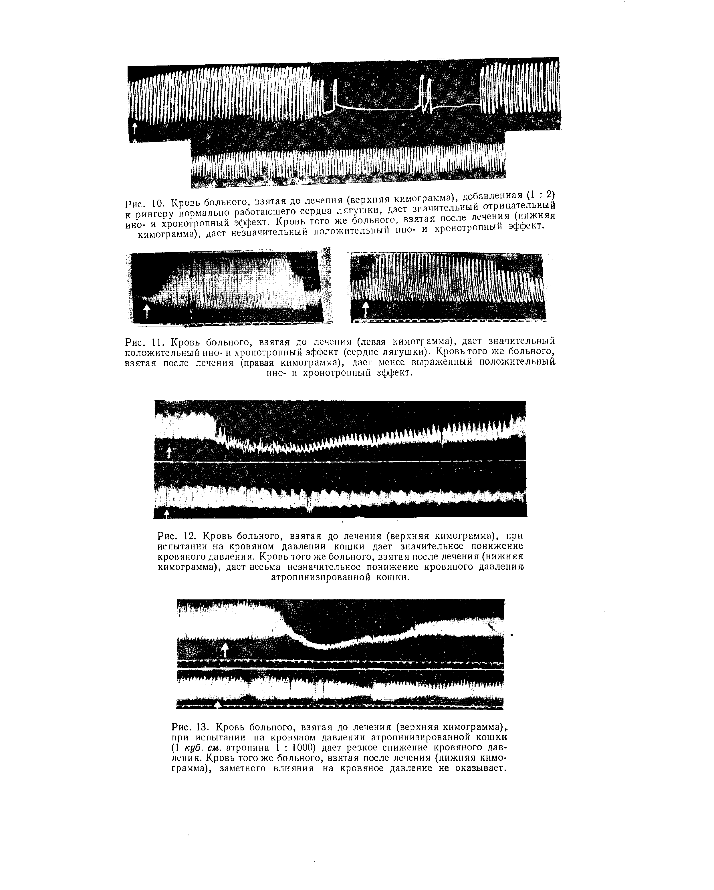 Рис. 11. Кровь больного, взятая до лечения (левая кимограмма), дает значительный положительный ино- и хронотропный эффект (сердце лягушки). Кровь того же больного, взятая после лечения (правая кимограмма), дает менее выраженный положительный, ино- и хронотропный эффект.