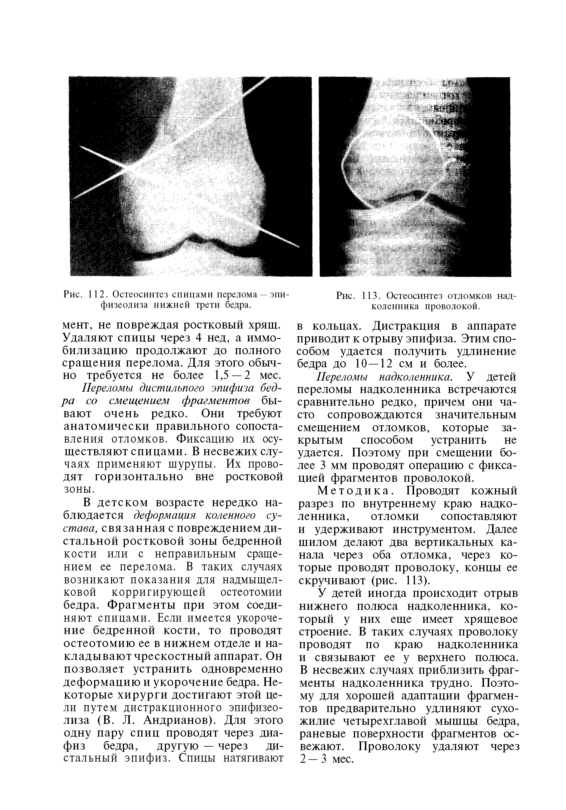 Рис. 112. Остеосинтез спицами перелома —эпи физеолиза нижней трети бедра.