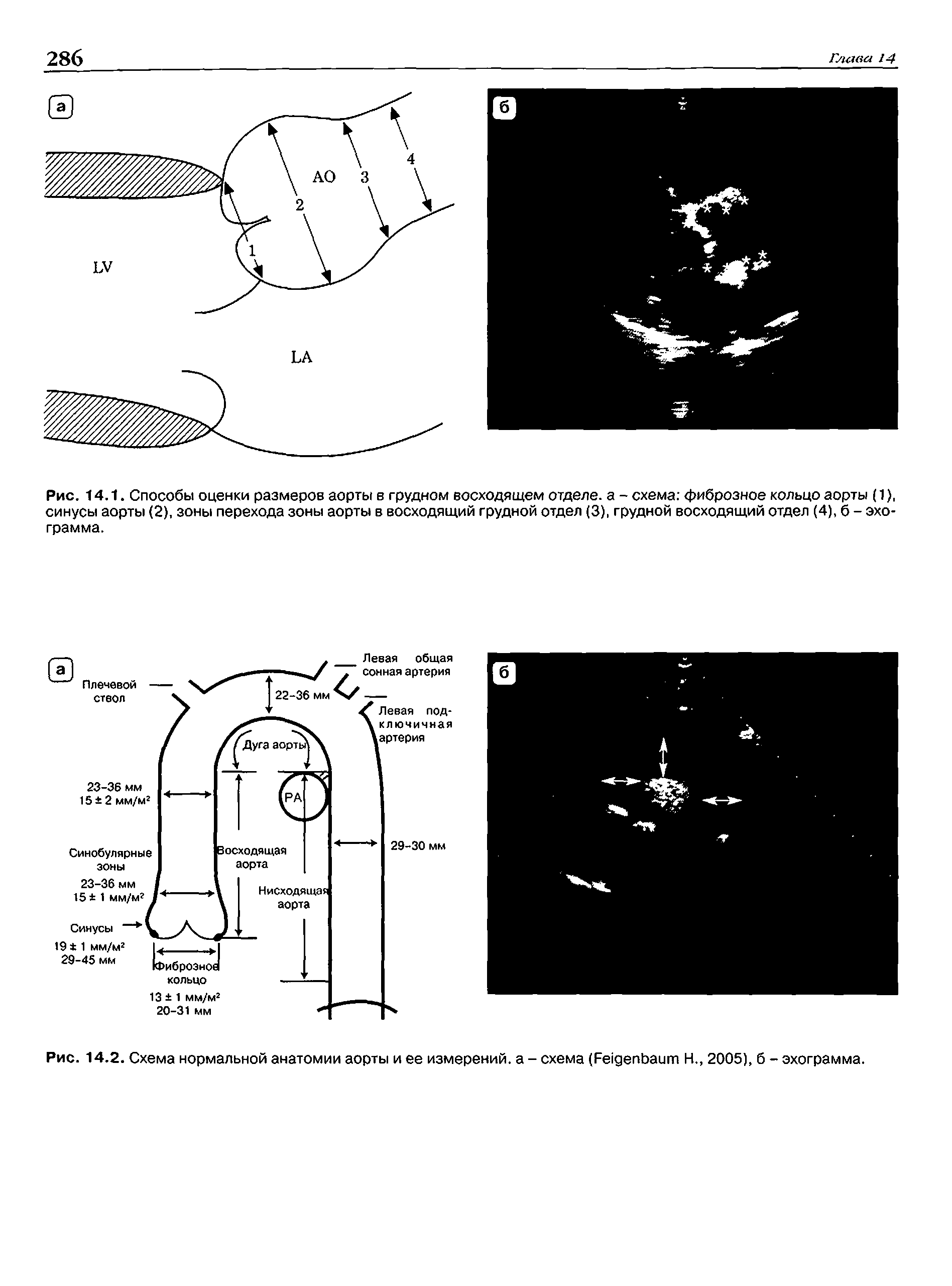 Рис. 14.2. Схема нормальной анатомии аорты и ее измерений, а - схема (F Н., 2005), б - эхограмма.