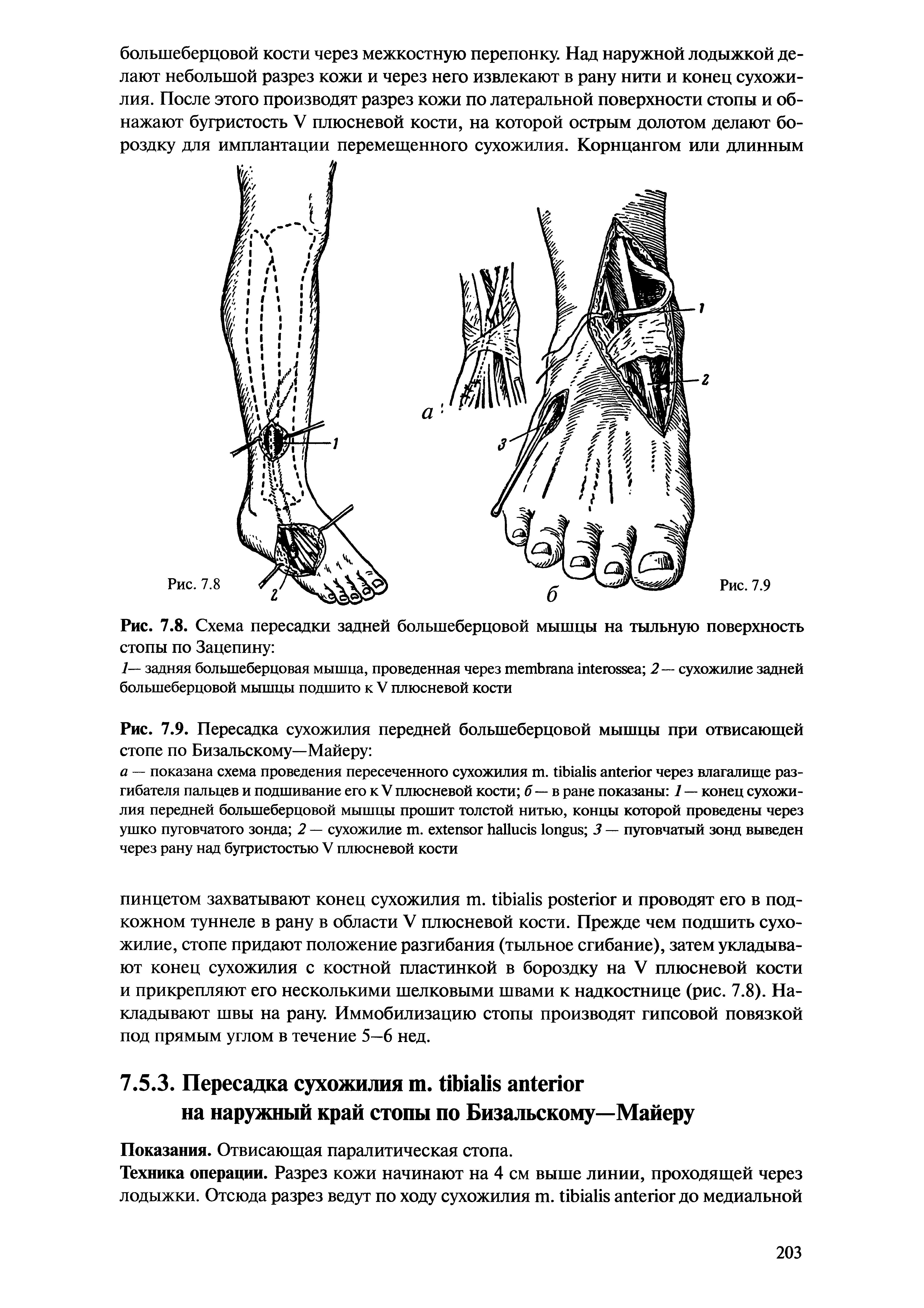 Рис. 7.9. Пересадка сухожилия передней большеберцовой мышцы при отвисающей стопе по Бизальскому—Майеру ...