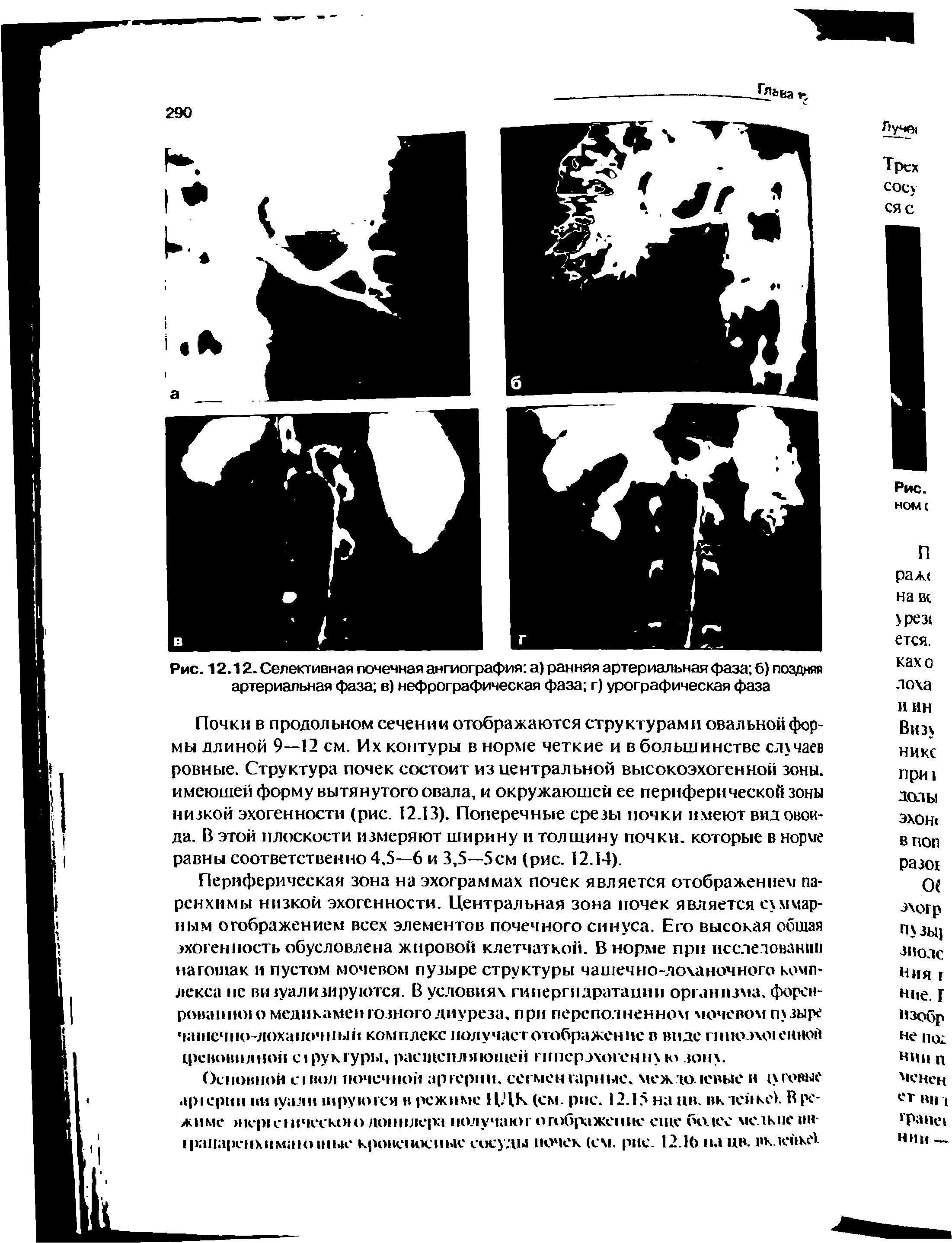 Рис. 12.12. Селективная почечная ангиография а) ранняя артериальная фаза б) поздняя артериальная фаза в) нефрографическая фаза г) урографическая фаза...