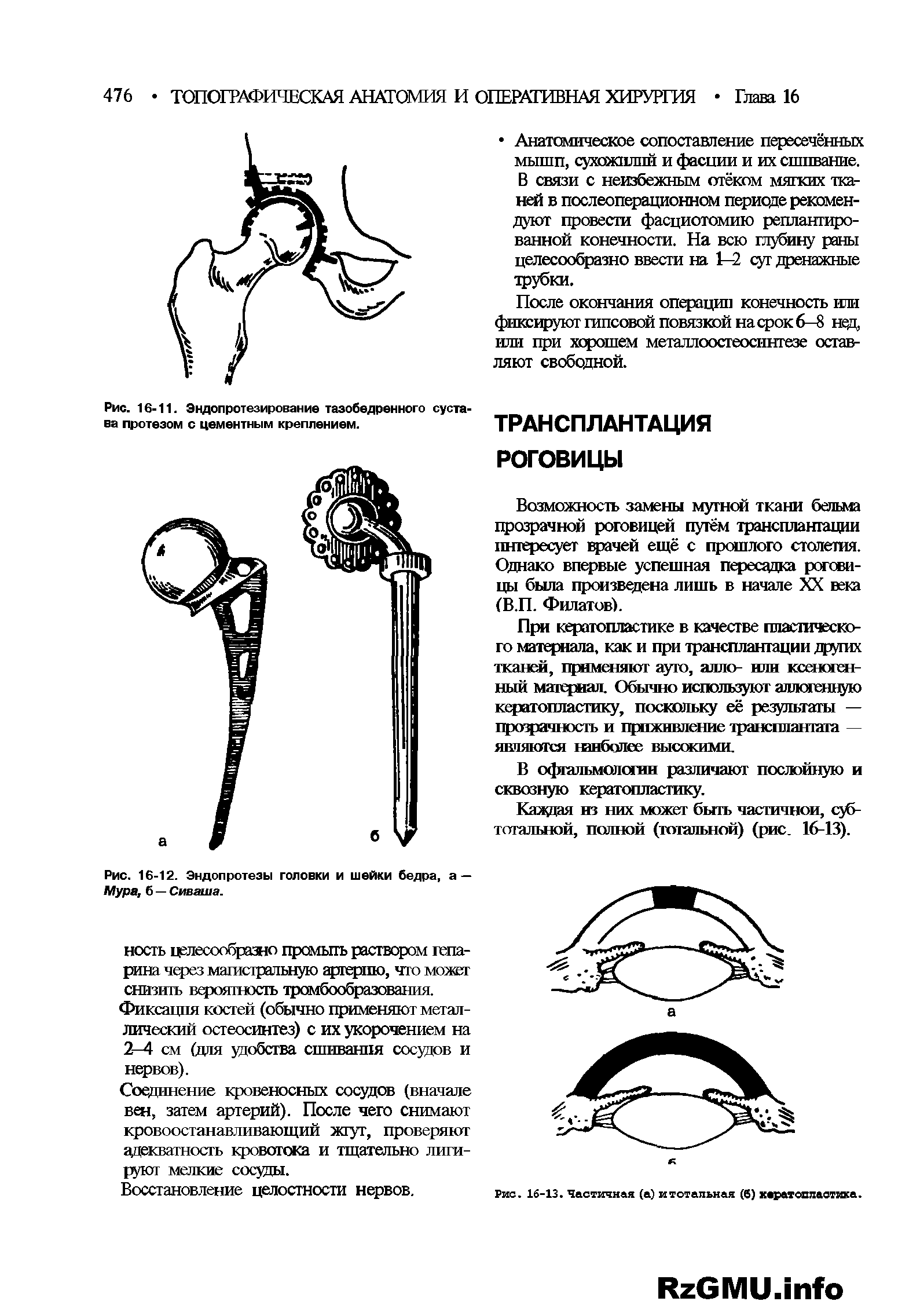 Рис. 16-12. Эндопротезы головки и шейки бедра, а — Мура, б — Сиваша.