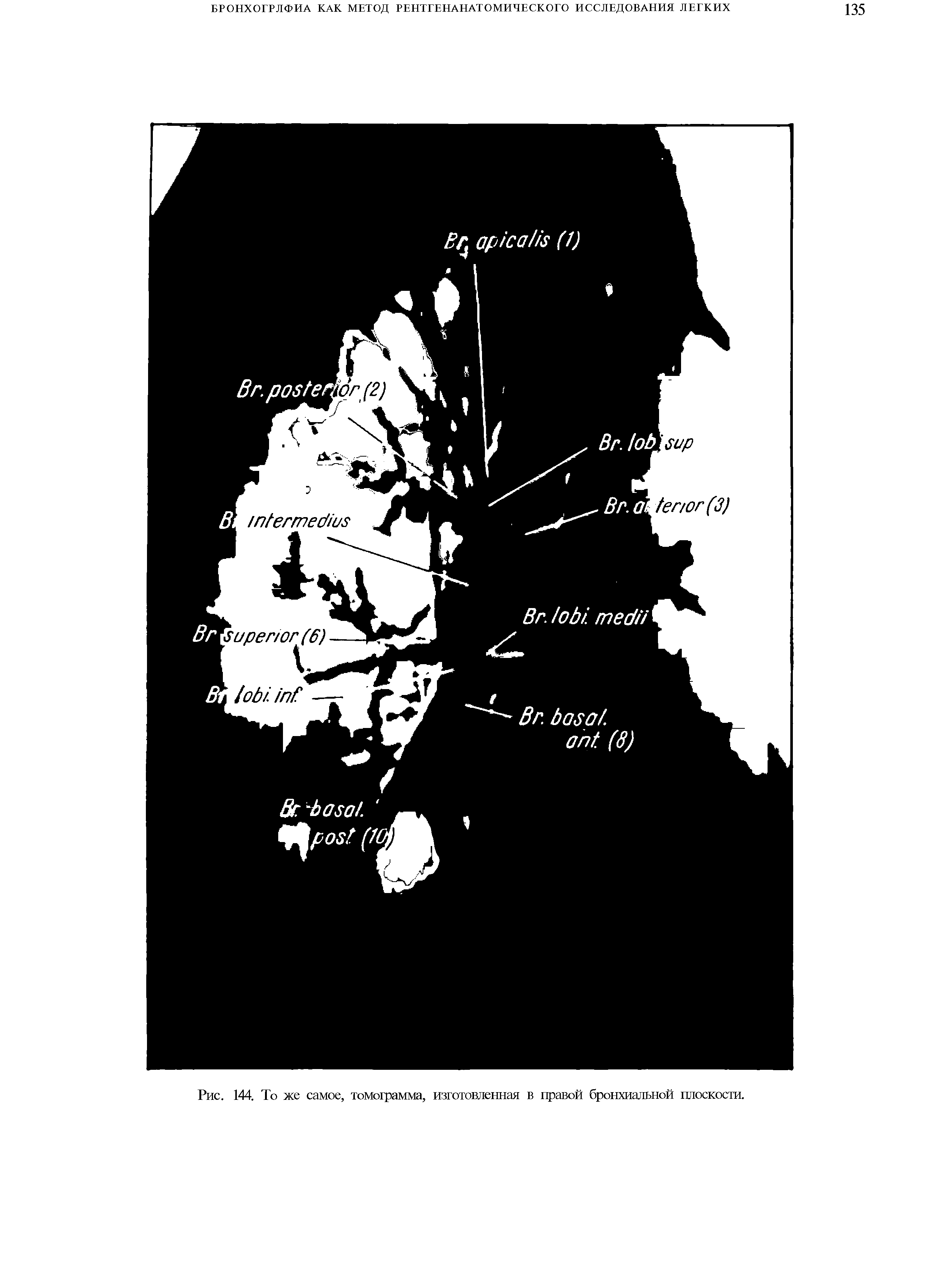 Рис. 144. То же самое, томограмма, изготовленная в правой бронхиальной плоскости.
