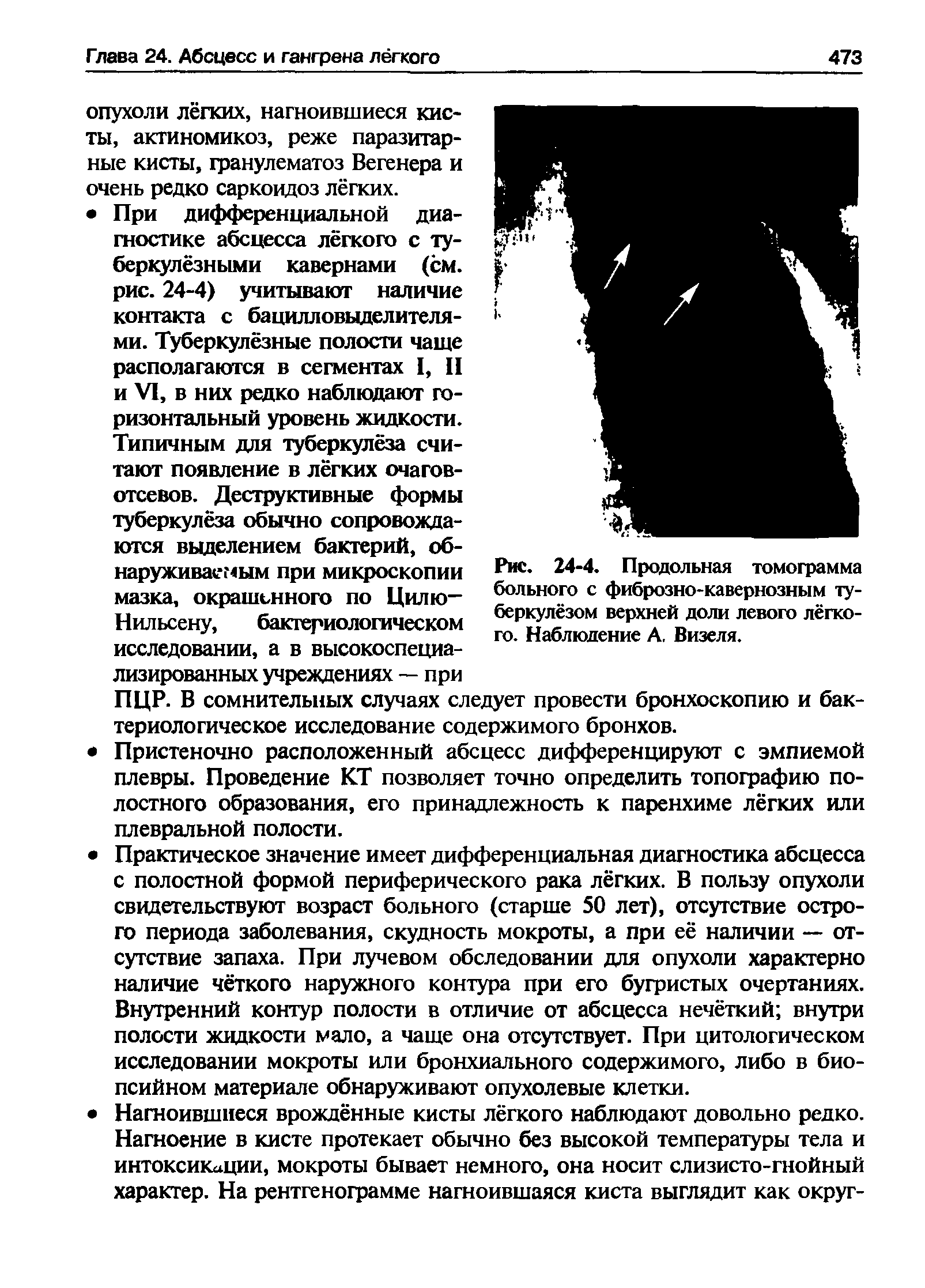 Рис. 24-4. Продольная томограмма больного с фиброзно-кавернозным туберкулёзом верхней доли левого лёгкого. Наблюдение А. Визеля.