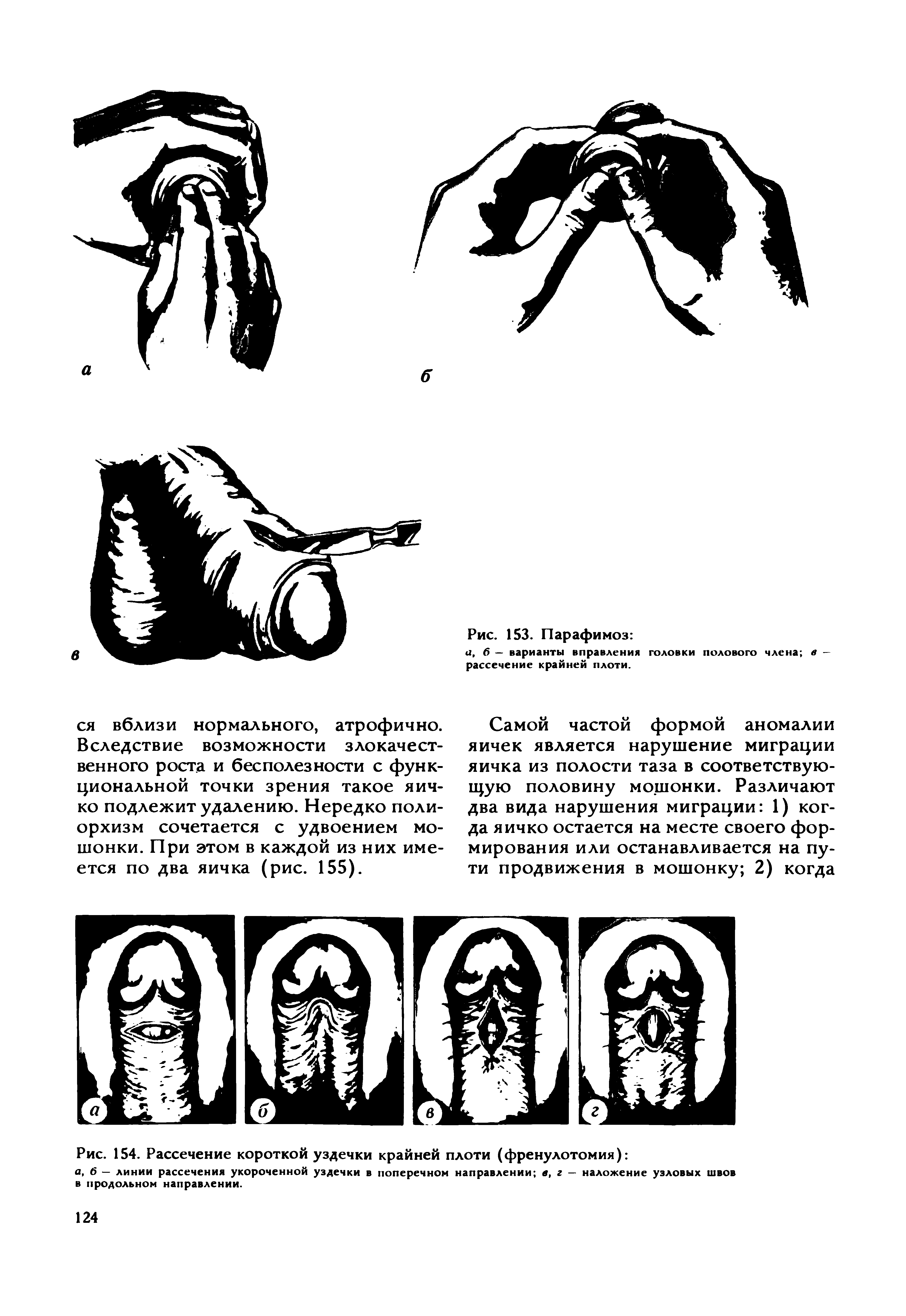 Рис. 154. Рассечение короткой уздечки крайней плоти (френулотомия) ...