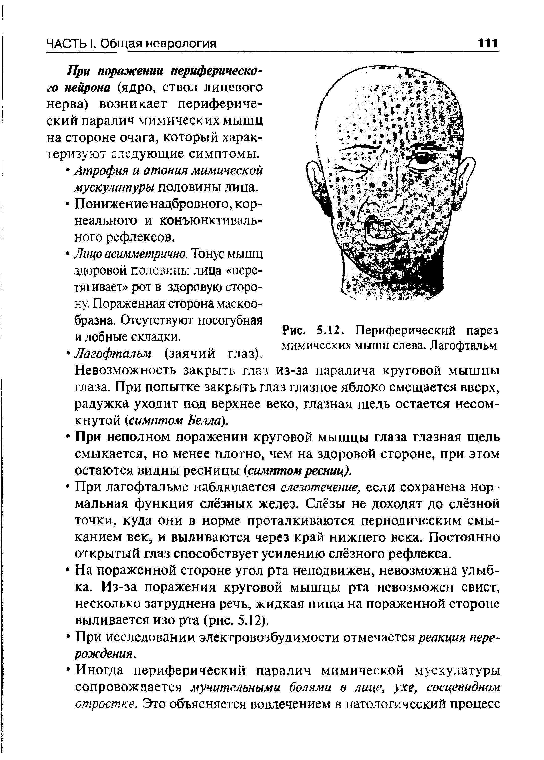 Рис. 5.12. Периферический парез мимических мышц слева. Лагофтальм из-за паралича круговой мышцы аз глазное яблоко смещается вверх.