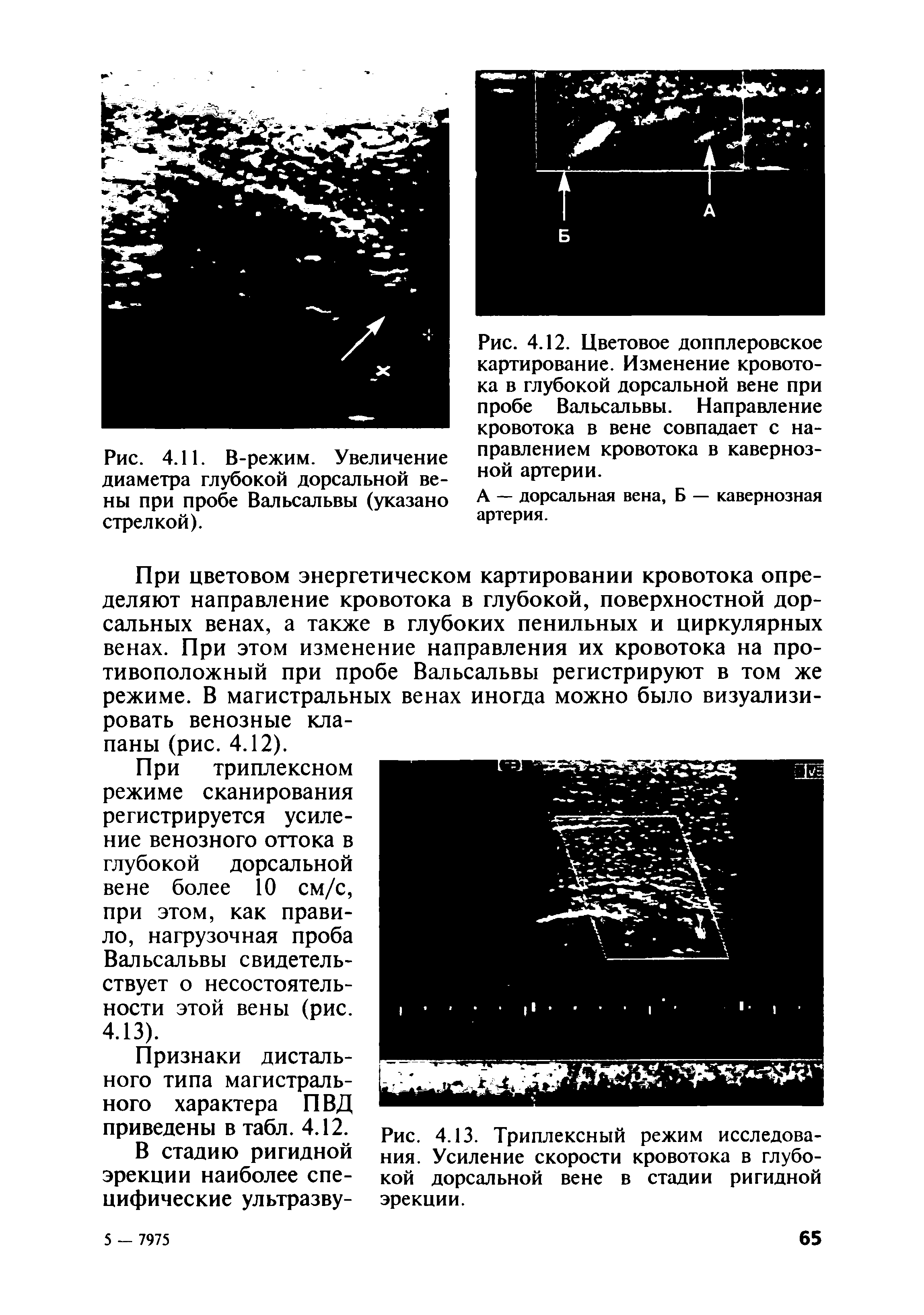 Рис. 4.13. Триплексный режим исследования. Усиление скорости кровотока в глубокой дорсальной вене в стадии ригидной эрекции.