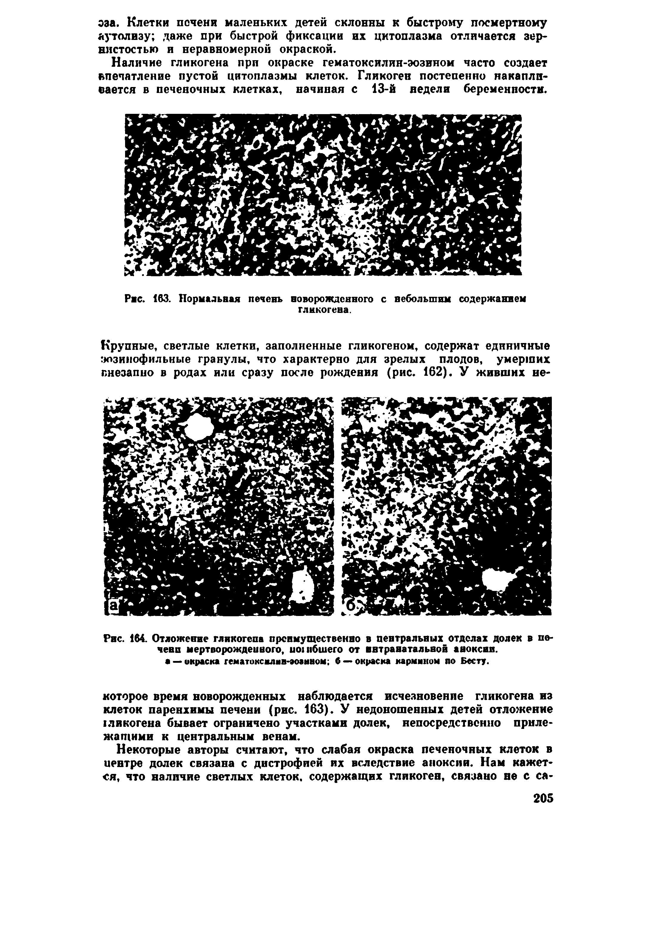 Рис. 164. Отложение гликогена преимущественно в центральных отделах долек в печени мертворожденного, погибшего от ввтранатальвой аноксии, а — окраска гематоксклив-аоманом б — окраска кармином по Бесту.