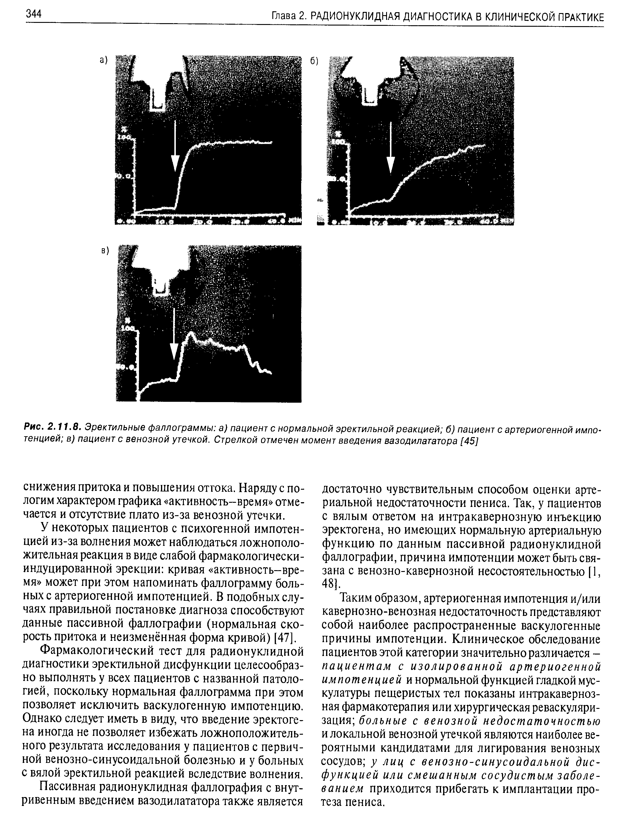 Рис. 2.11.8. Эректильные фаллограммы а) пациент с нормальной эректильной реакцией б) пациент с артериогенной импотенцией в) пациенте венозной утечкой. Стрелкой отмечен момент введения вазодилататора [45]...