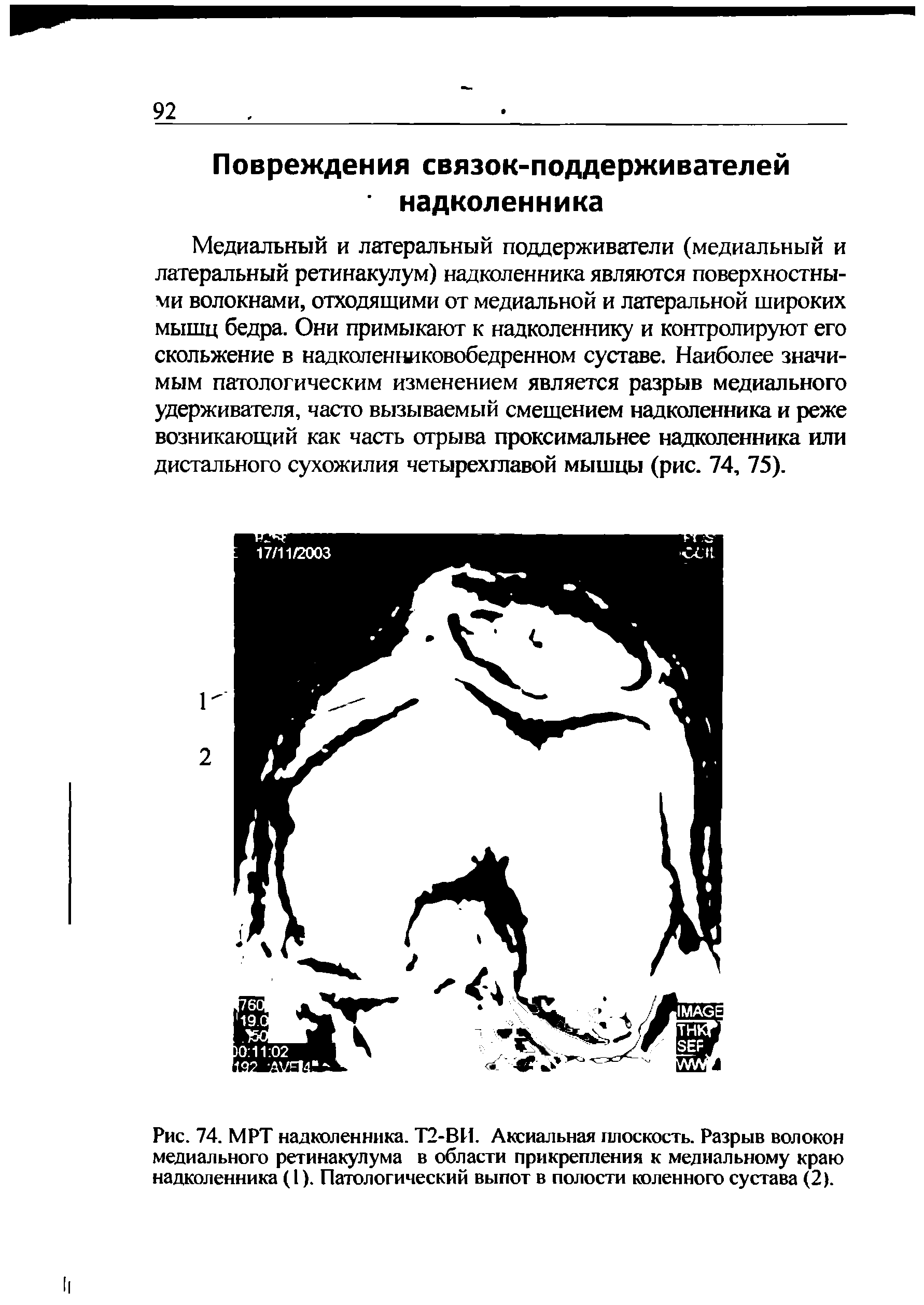 Рис. 74. МРТ надколенника. Т2-ВИ. Аксиальная плоскость. Разрыв волокон медиального ретинакулума в области прикрепления к медиальному краю надколенника (1). Патологический выпот в полости коленного сустава (2).