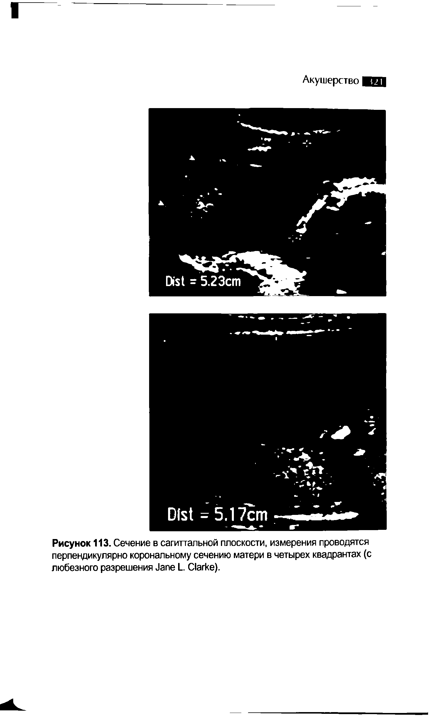 Рисунок 113. Сечение в сагиттальной плоскости, измерения проводятся перпендикулярно корональному сечению матери в четырех квадрантах (с любезного разрешения J L. C ).