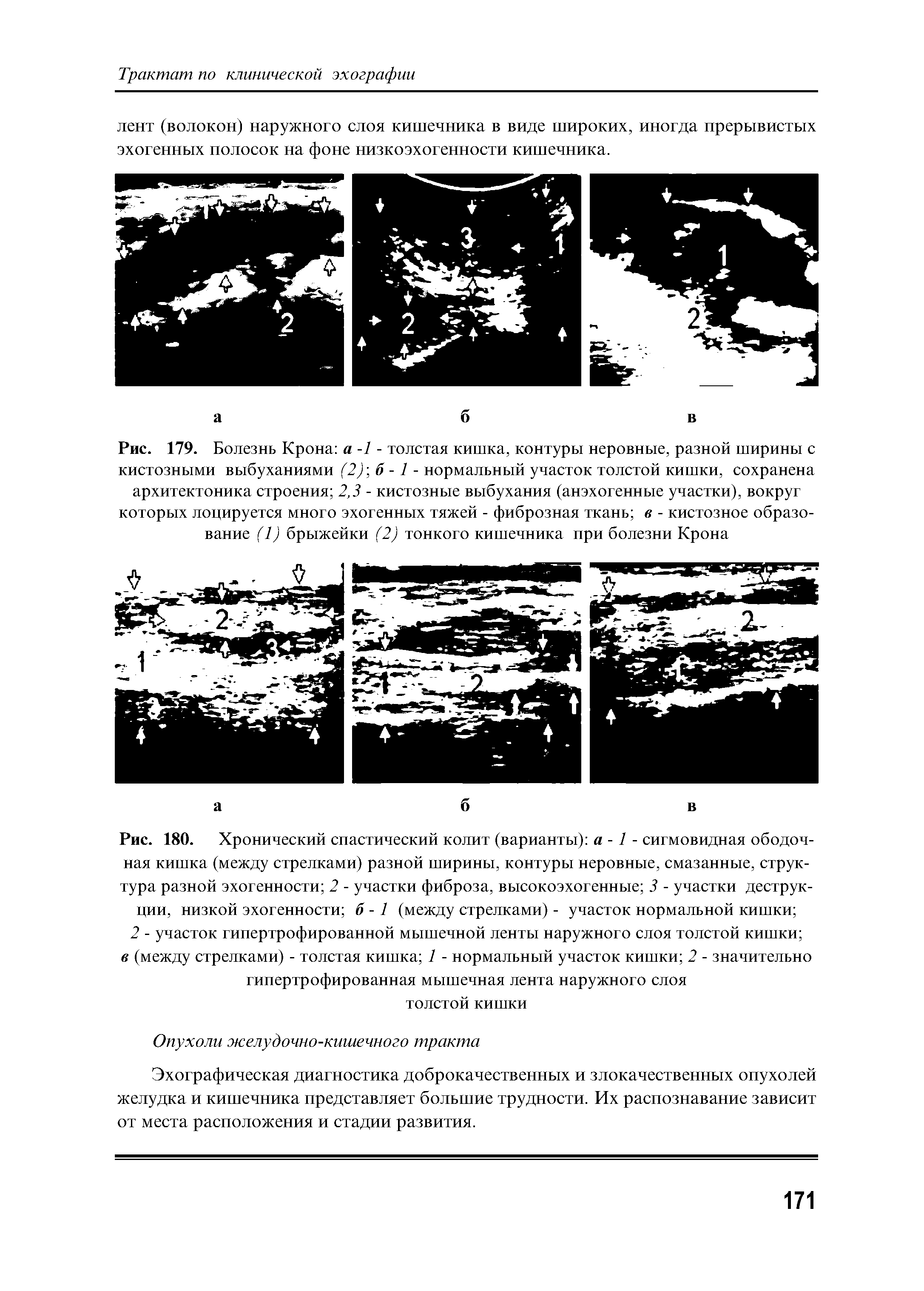 Рис. 180. Хронический спастический колит (варианты) а -1 - сигмовидная ободочная кишка (между стрелками) разной ширины, контуры неровные, смазанные, структура разной эхогенности 2 - участки фиброза, высокоэхогенные 3 - участки деструкции, низкой эхогенности б -1 (между стрелками) - участок нормальной кишки ...