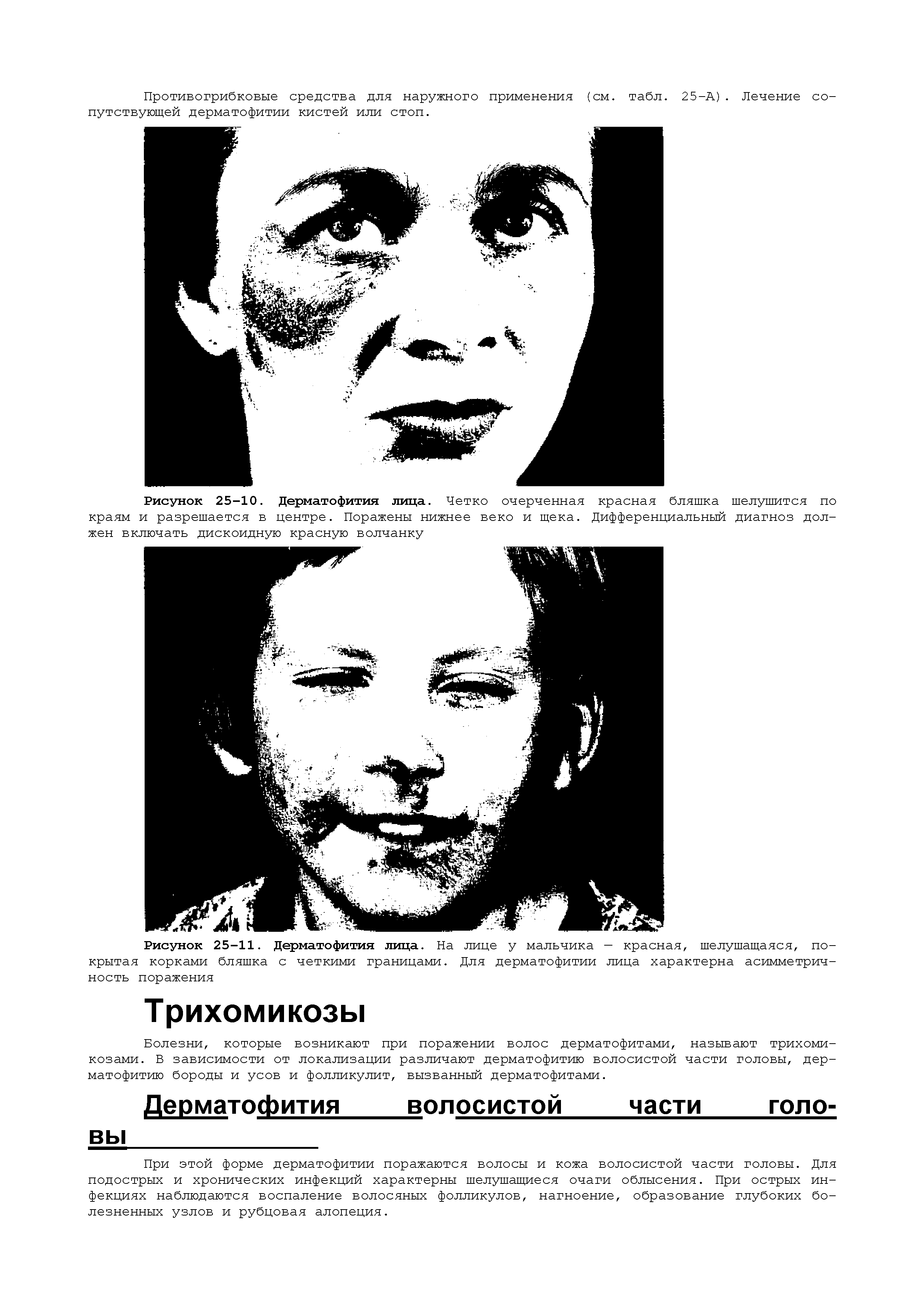 Рисунок 25-10. Дерматофития лица. Четко очерченная красная бляшка шелушится по краям и разрешается в центре. Поражены нижнее веко и щека. Дифференциальный диагноз должен включать дискоидную красную волчанку...