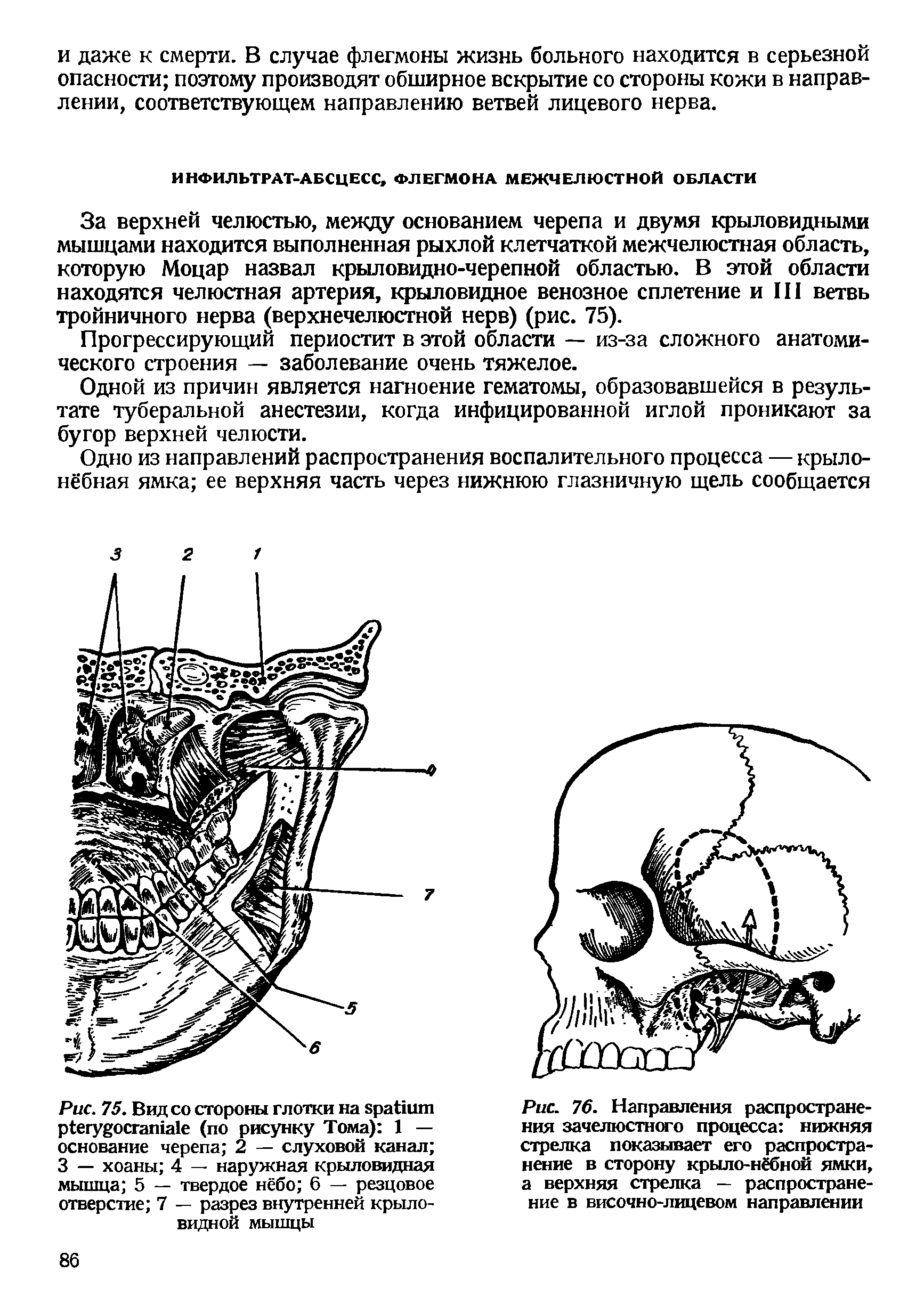 Рис. 76. Направления распространения зачелюстного процесса нижняя стрелка показывает его распространение в сторону крыло-нёбной ямки, а верхняя стрелка — распространение в височно-лицевом направлении...