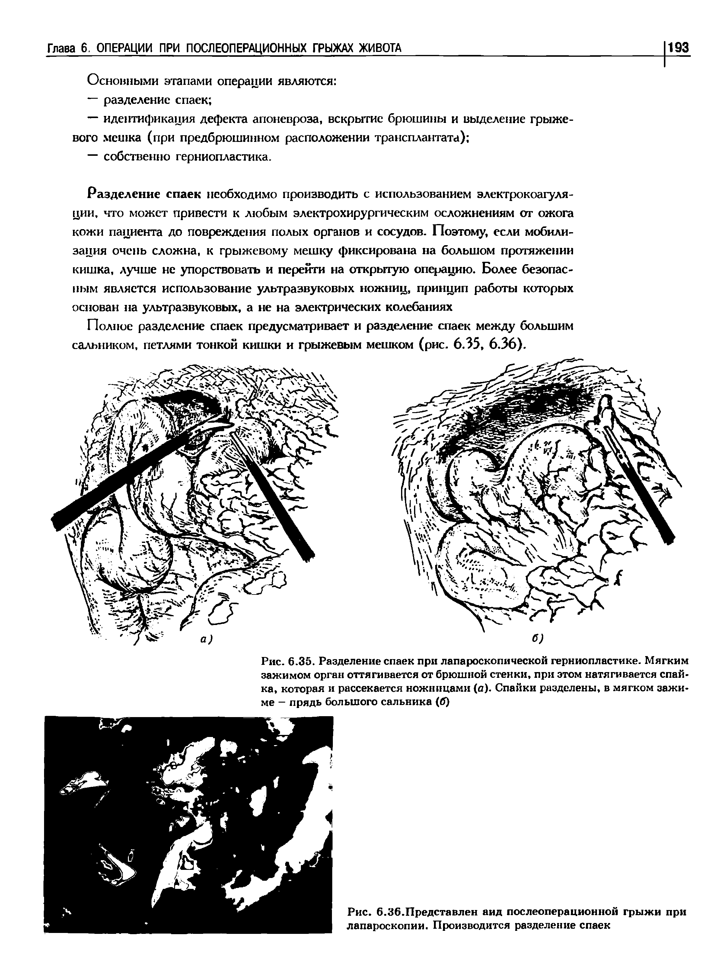 Рис. 6.35. Разделение спаек при лапароскопической герниопластике. Мягким зажимом орган оттягивается от брюшной стенки, при этом натягивается спайка, которая и рассекается ножницами (а). Спайки разделены, в мягком зажиме - прядь большого сальника (б)...
