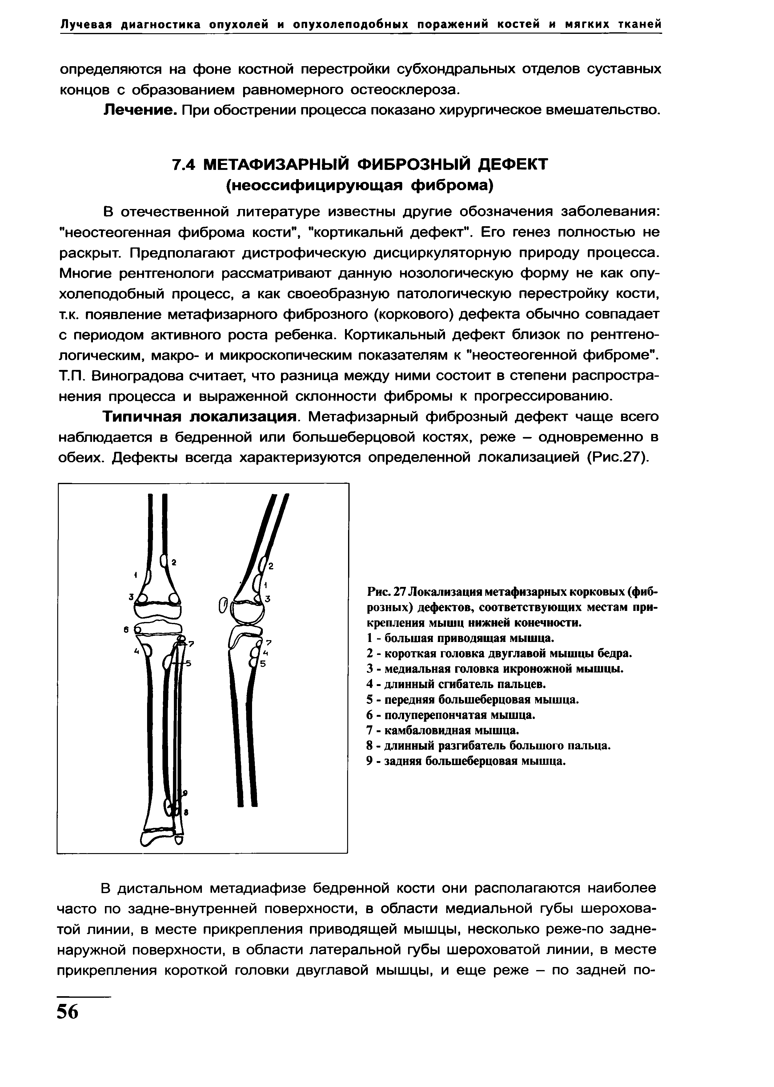 Рис. 27 Локализация метафизарных корковых (фиброзных) дефектов, соответствующих местам прикрепления мышц нижней конечности.