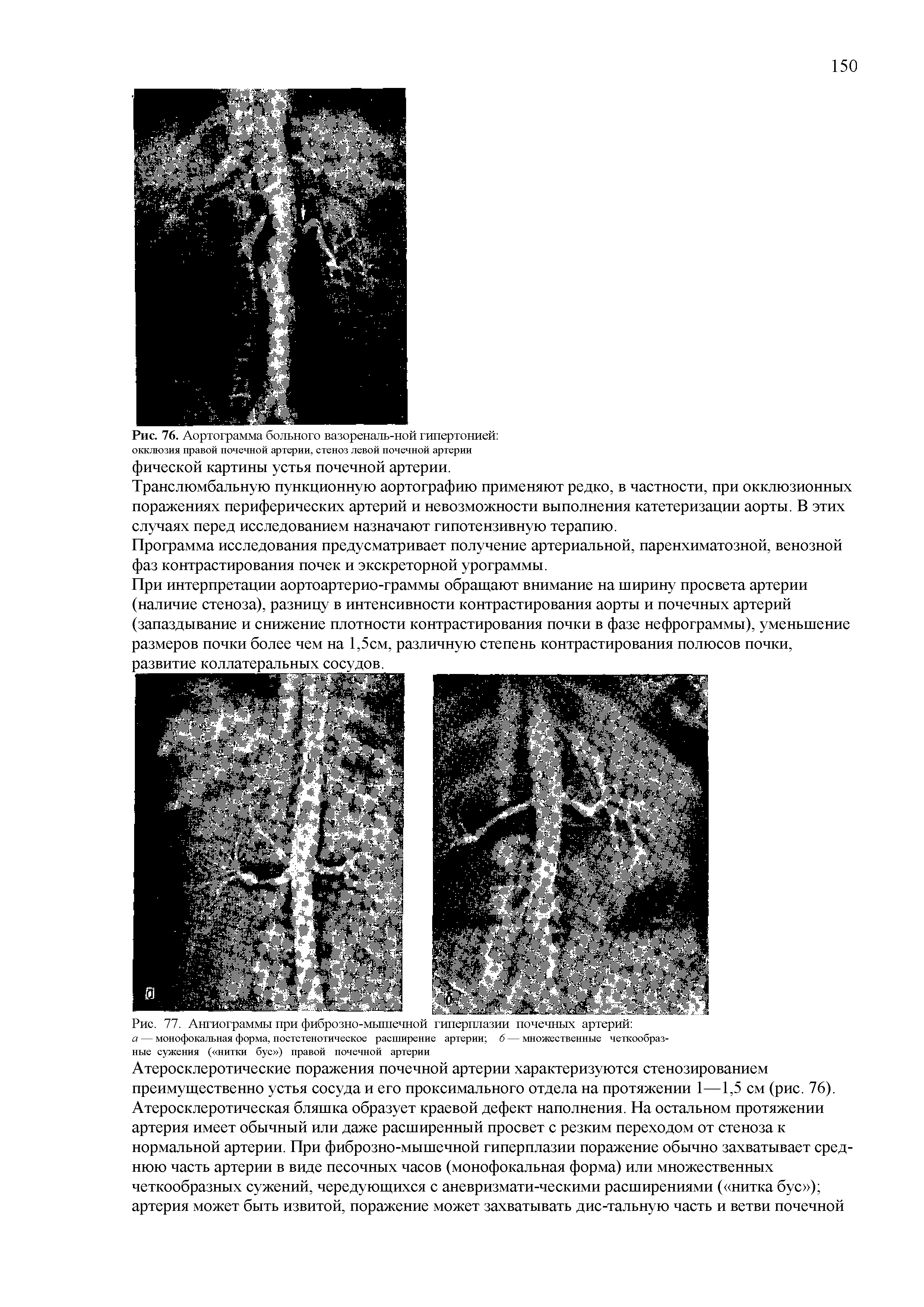 Рис. 77. Ангиограммы при фиброзно-мышечной гиперплазии почечных артерий а — монофокальная форма, постстенотическое расширение артерии 6 — множественные четкообразные сужения ( нитки бус ) правой почечной артерии...