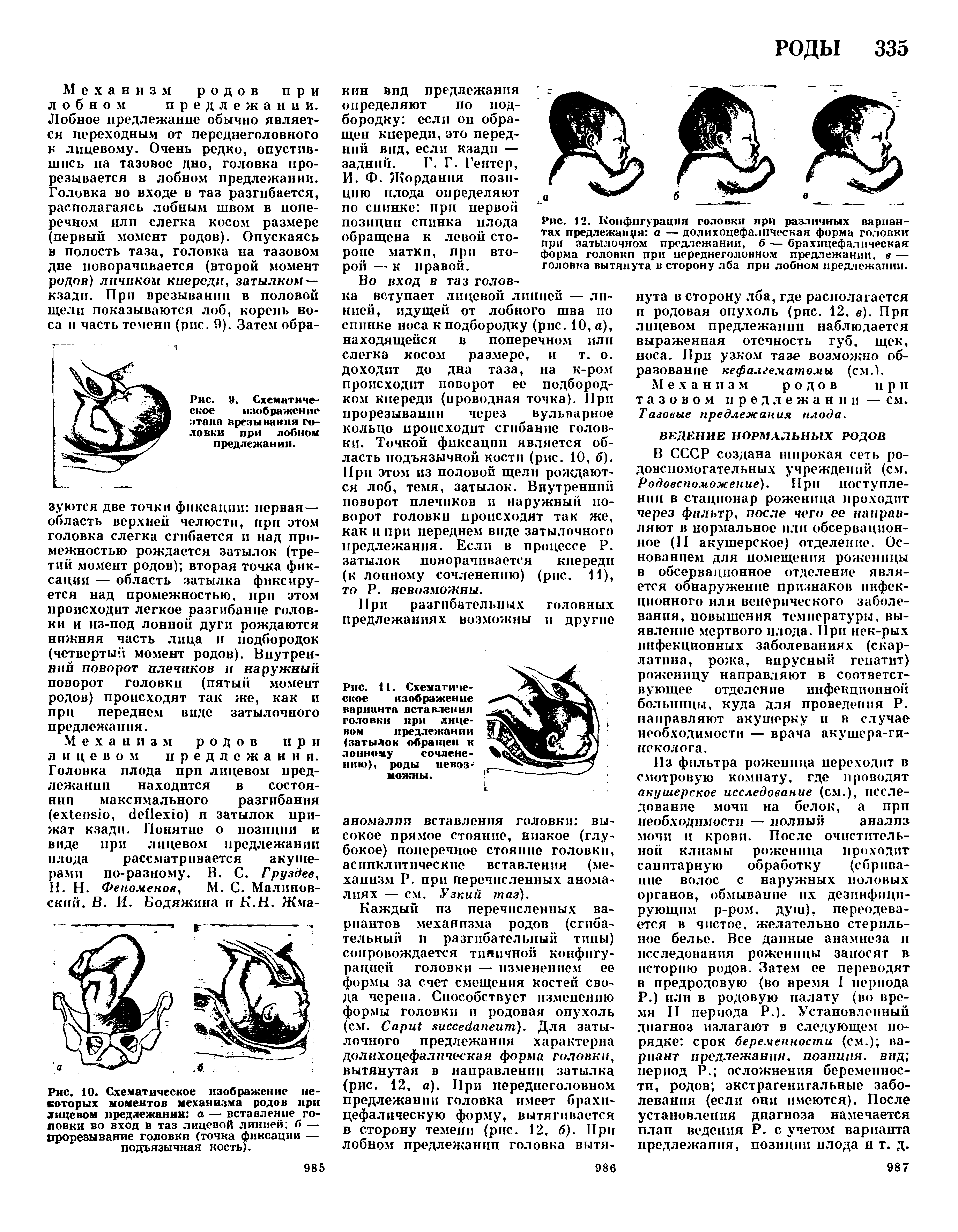 Рис. 12. Конфигурация головки при различных вариантах предлежанця а — долихоцефалпческая форма головки при затылочном предлежании, б — брахицефалическая форма головки при переднеголовном предлежании, в — головка вытянута в сторону лба при лобном предлежании.