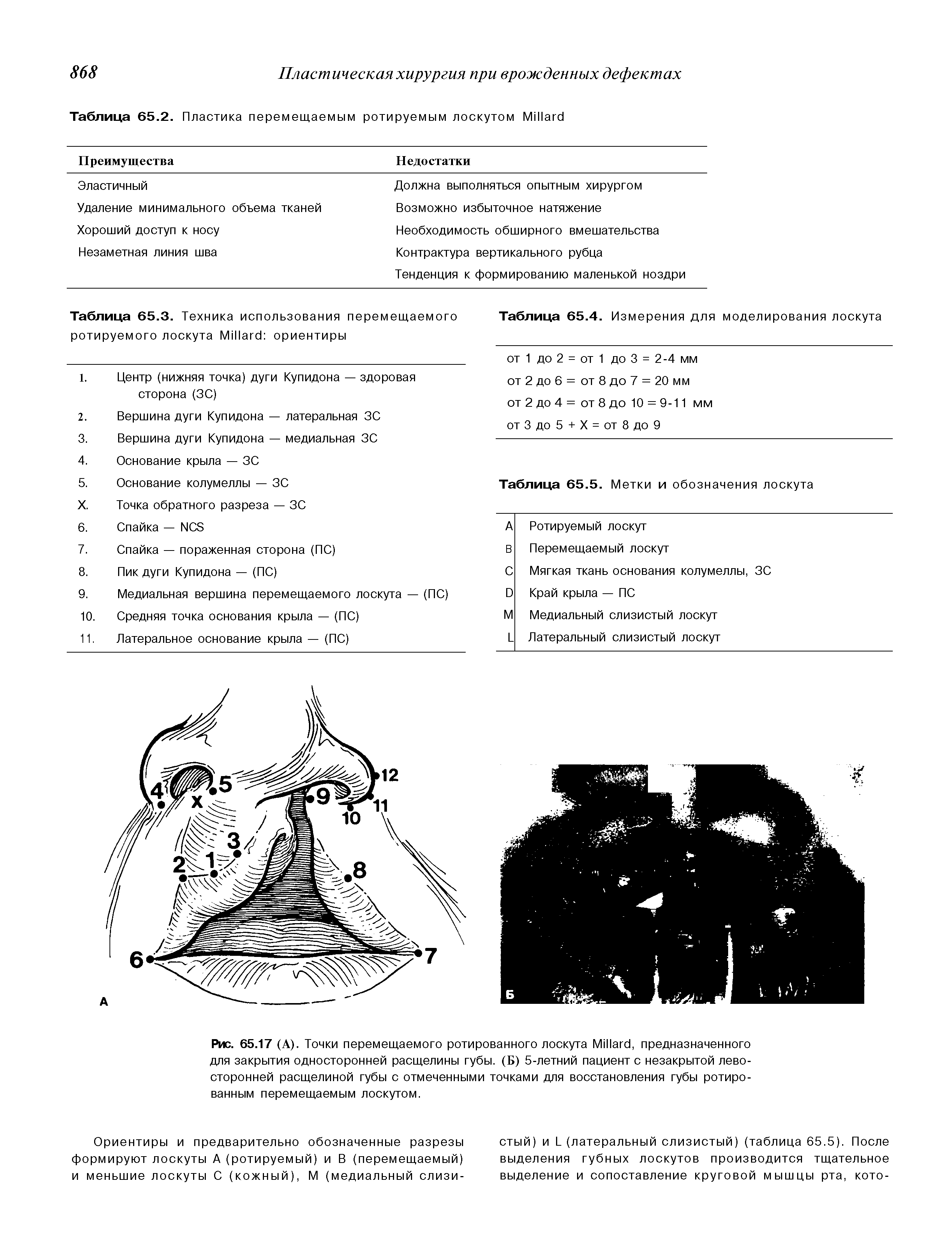 Таблица 65.2. Пластика перемещаемым ротируемым лоскутом M ...