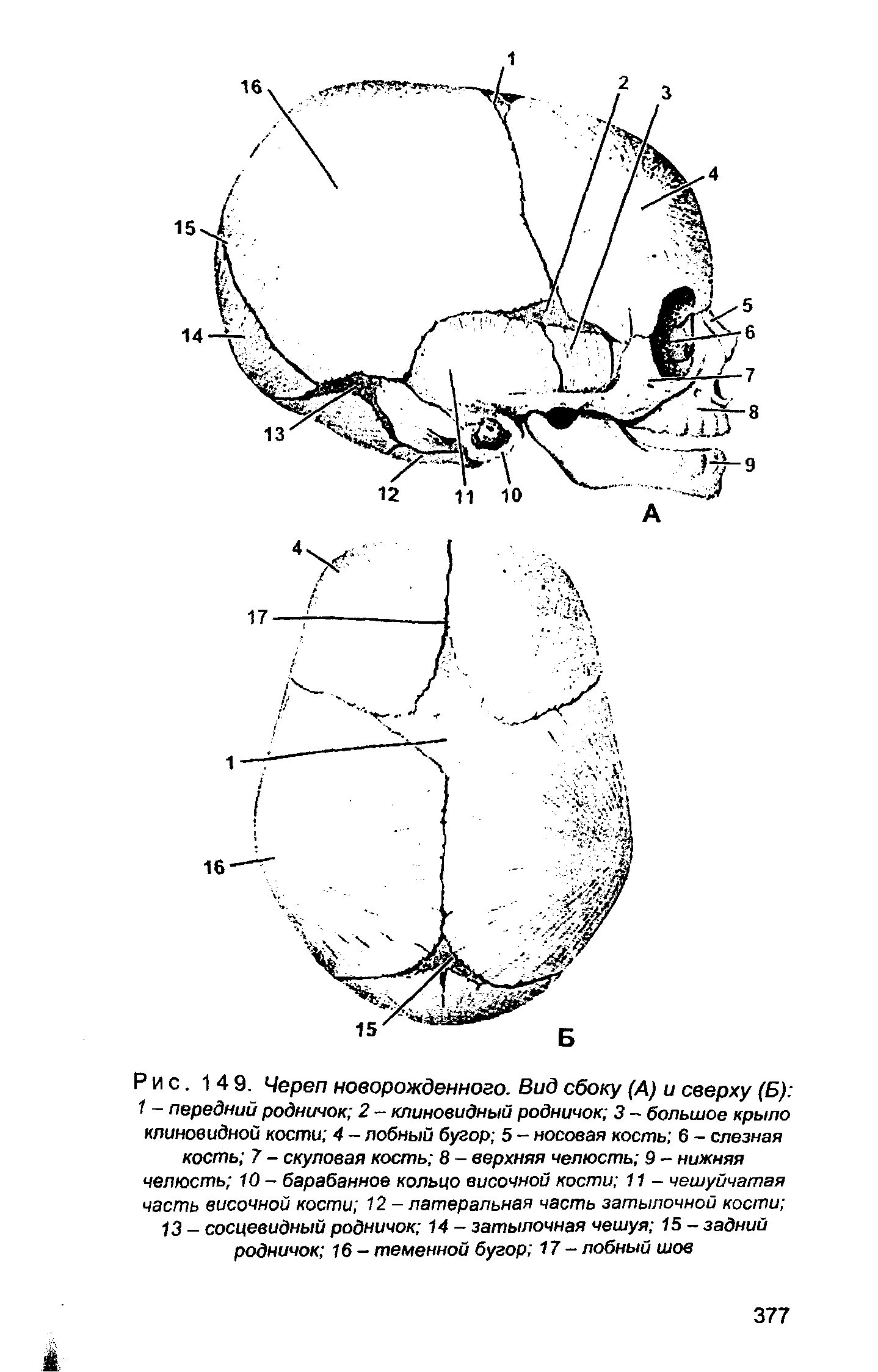 Рис. 149. Череп новорожденного. Вид сбоку (А) и сверху (Б) 1 - передний родничок 2 - клиновидный родничок 3 - большое крыло клиновидной кости 4 - лобный бугор 5 - носовая кость 6 - слезная кость 7 - скуловая кость 8 - верхняя челюсть 9 - нижняя челюсть 10- барабанное кольцо височной кости 11 - чешуйчатая часть височной кости 12 - латеральная часть затылочной кости ...