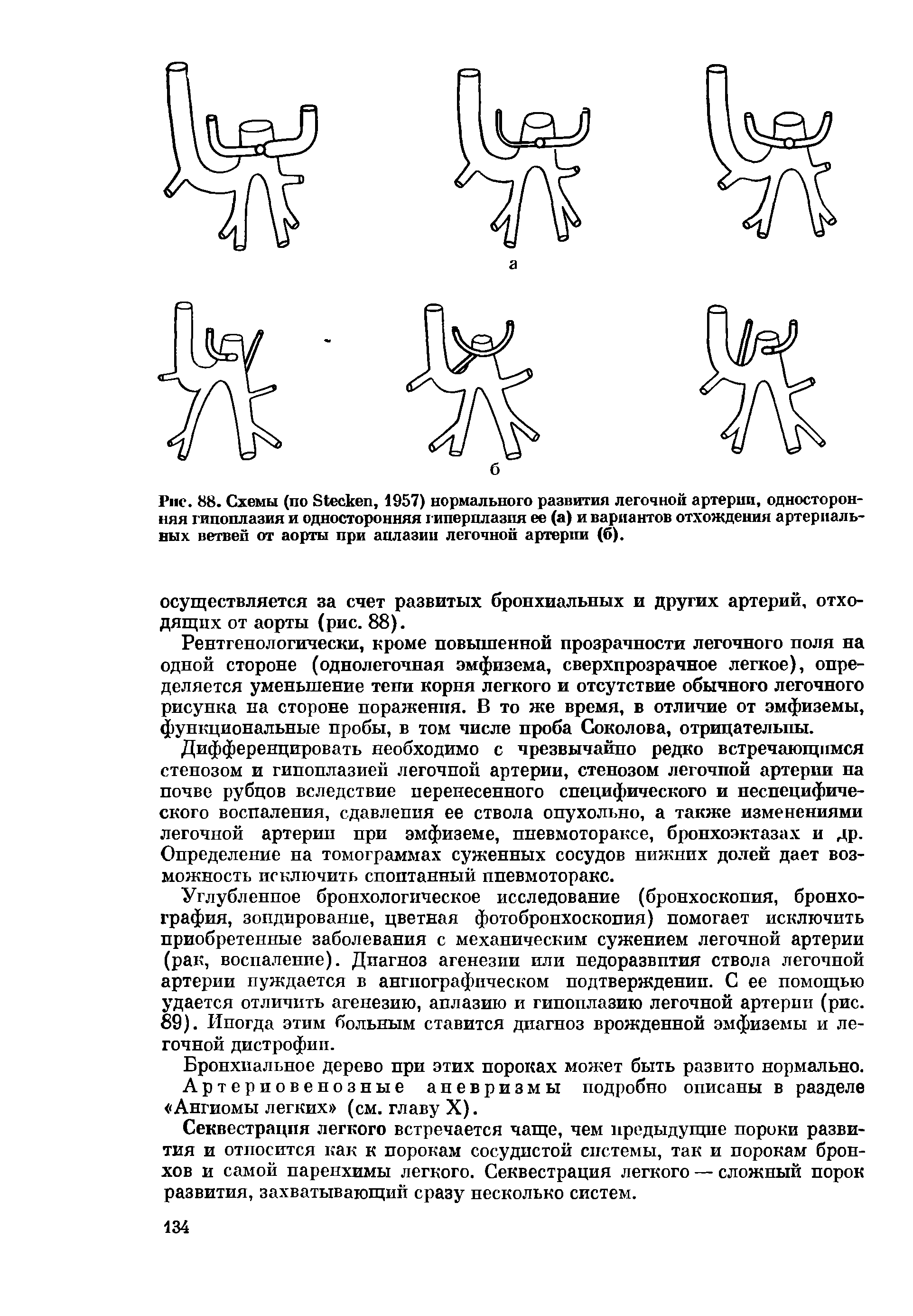 Рис. 88. Схемы (по S , 1957) нормального развития легочной артерии, односторонняя гипоплазия и односторонняя гиперплазия ее (а) и вариантов отхождения артериальных ветвей от аорты при аплазии легочной артерии (б).