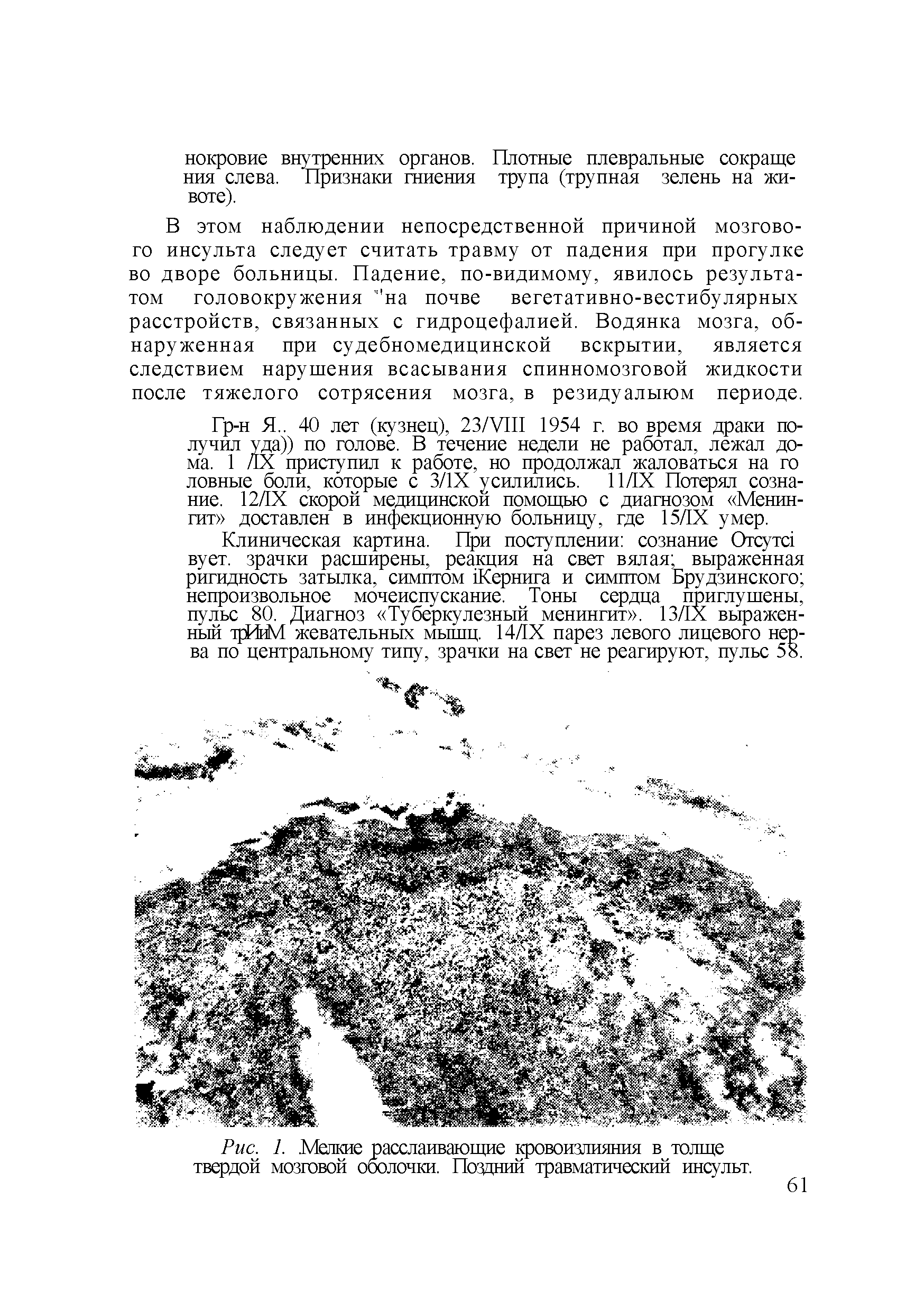 Рис. 1. Мелкие расслаивающие кровоизлияния в толще твердой мозговой оболочки. Поздний травматический инсульт.