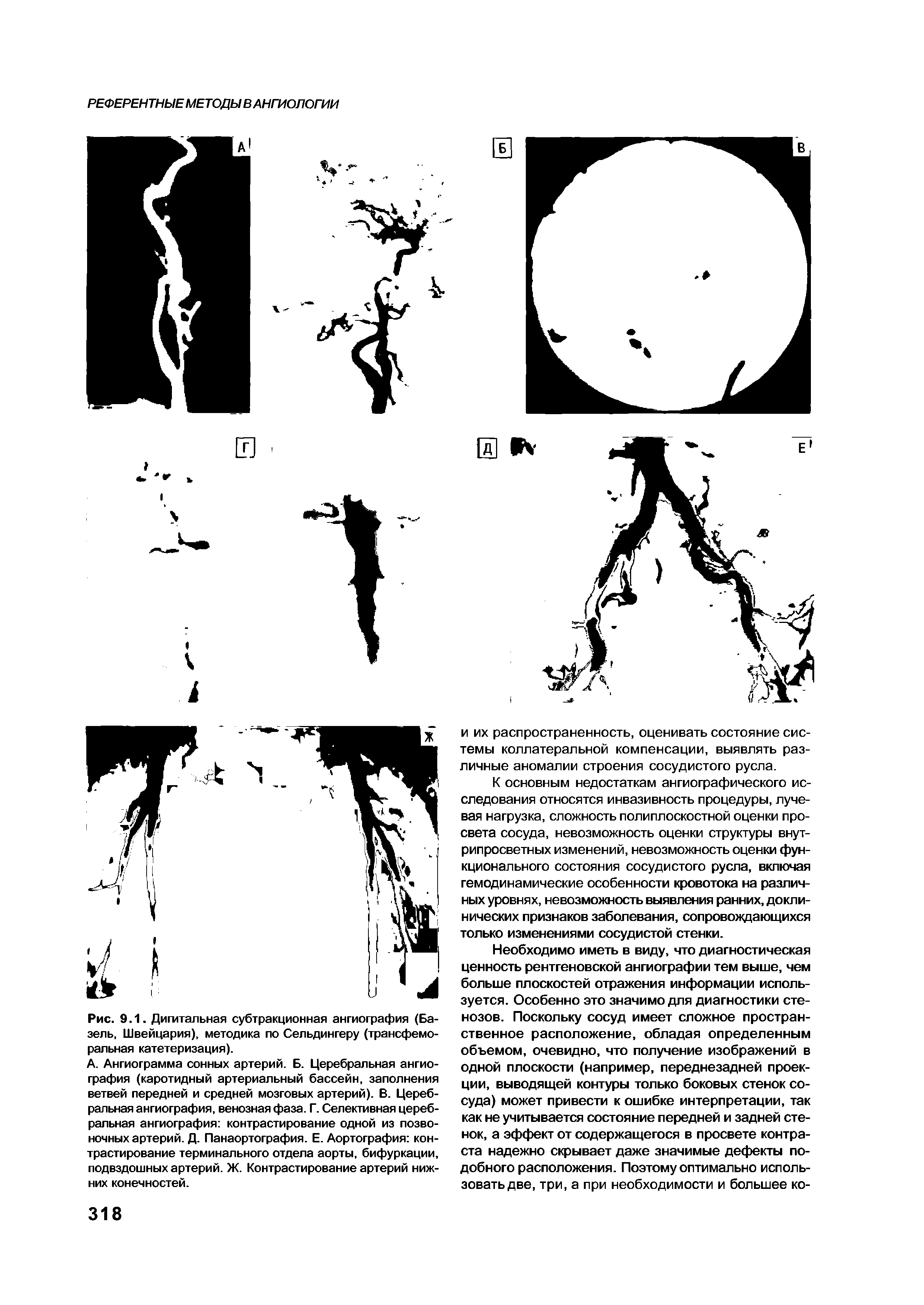 Рис. 9.1. Дигитальная субтракционная ангиография (Базель, Швейцария), методика по Сельдингеру (трансфеморальная катетеризация).