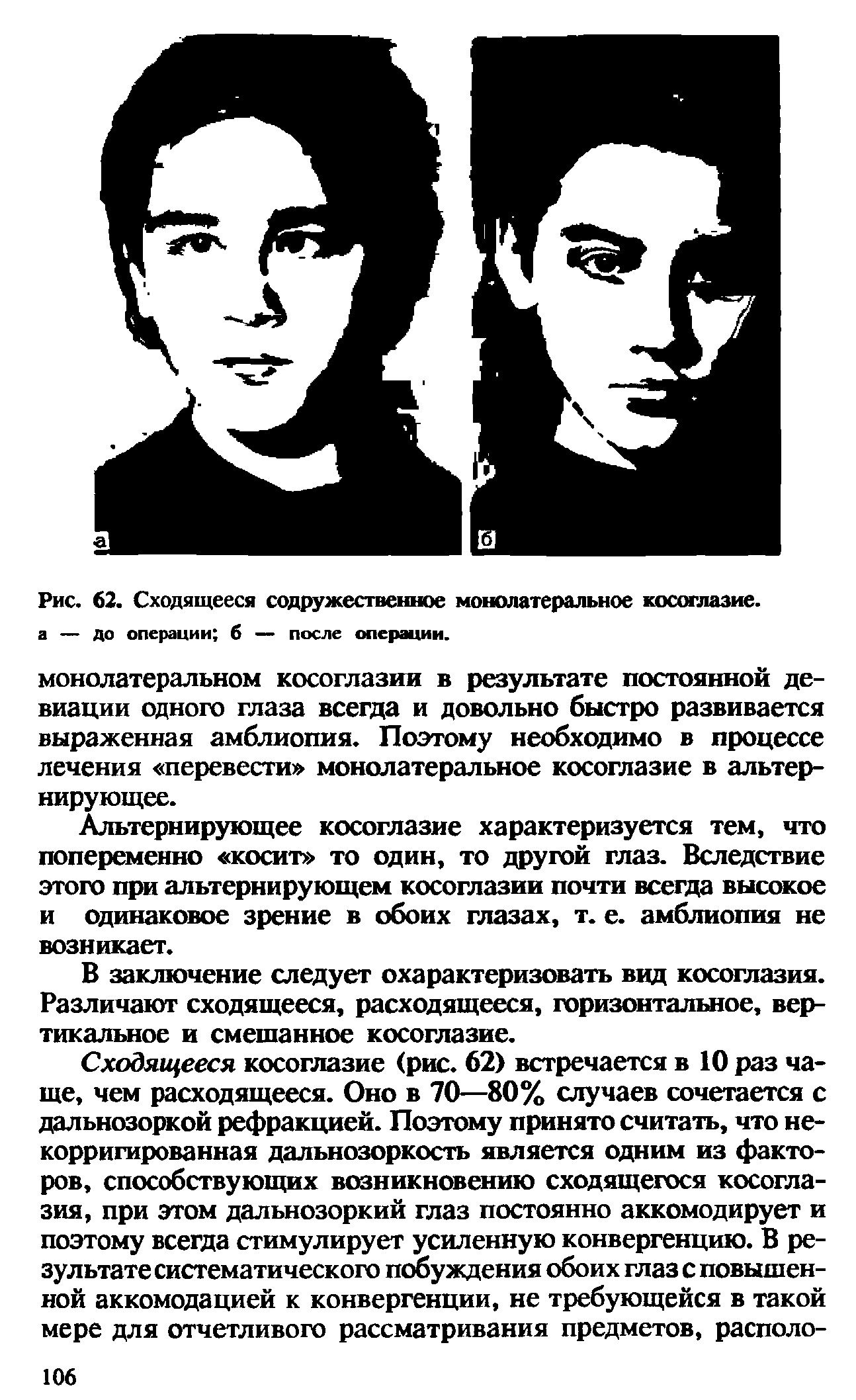 Рис. 62. Сходящееся содружественное монолатеральное косоглазие, а — до операции б — после операции.