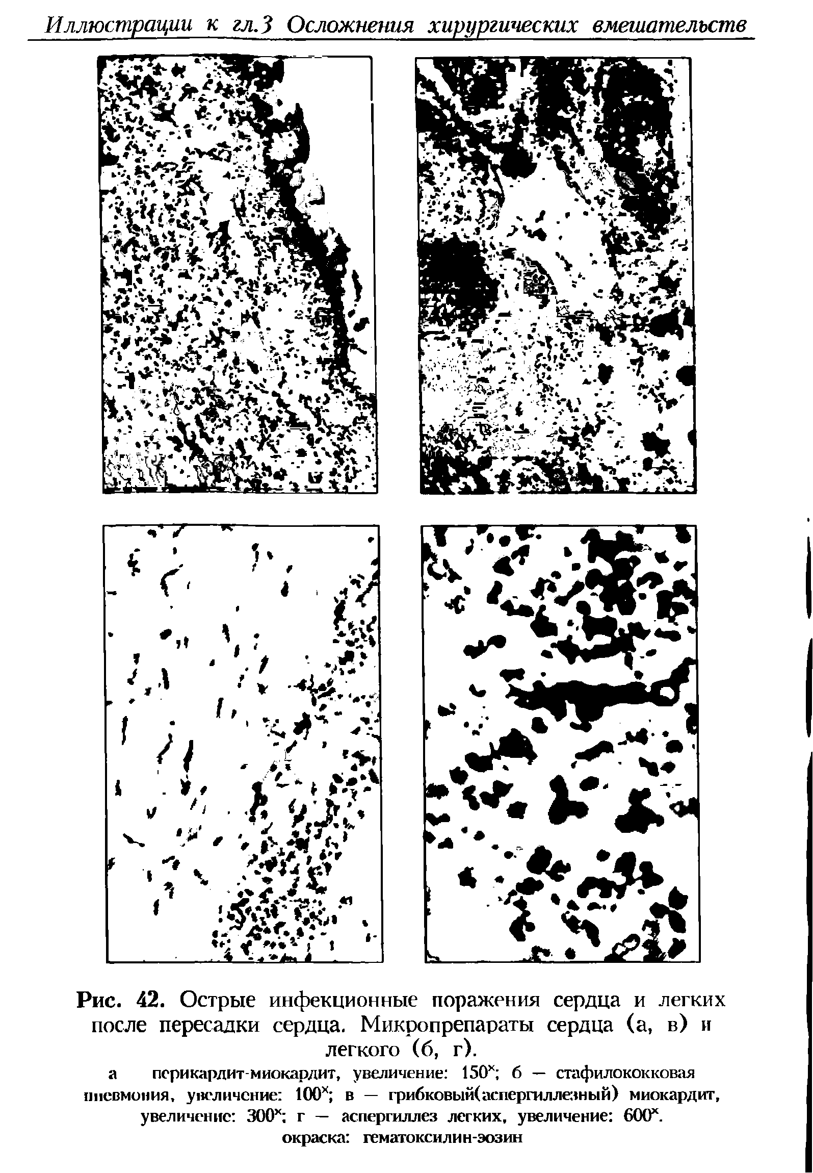 Рис. 42. Острые инфекционные поражения сердца и легких после пересадки сердца. Микропрепараты сердца (а, в) и легкого (б, г).