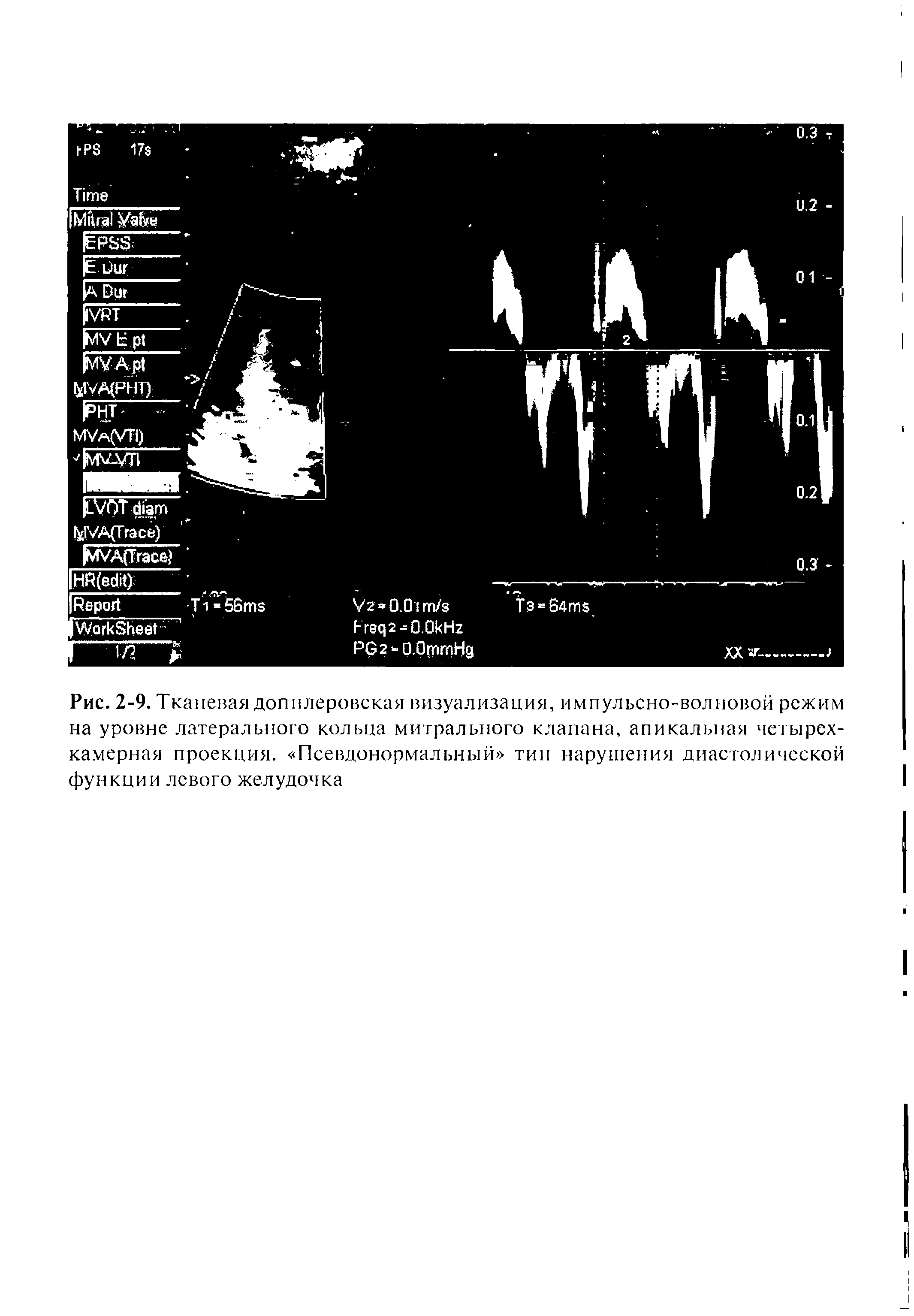 Рис. 2-9. Тканевая допплеровская визуализация, импульсно-волновой режим на уровне латерального кольца митрального клапана, апикальная четырехкамерная проекция. Псевдонормальный тип нарушения диастолической функции левого желудочка...