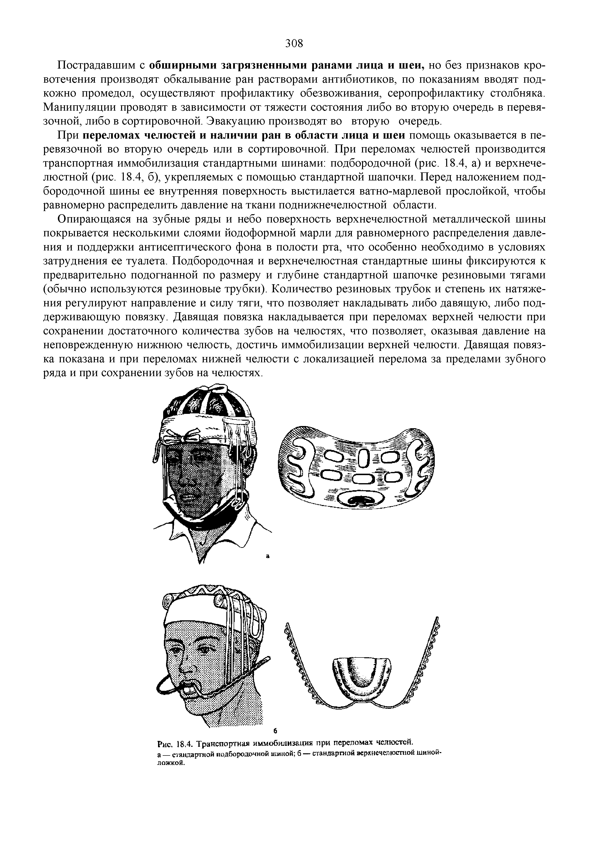 Рис. 18,4. Транспортная иммобилизация при переломах челюстей, а стандартной подбородочной шиной б — стандартной верхнечелюстной шиной-...