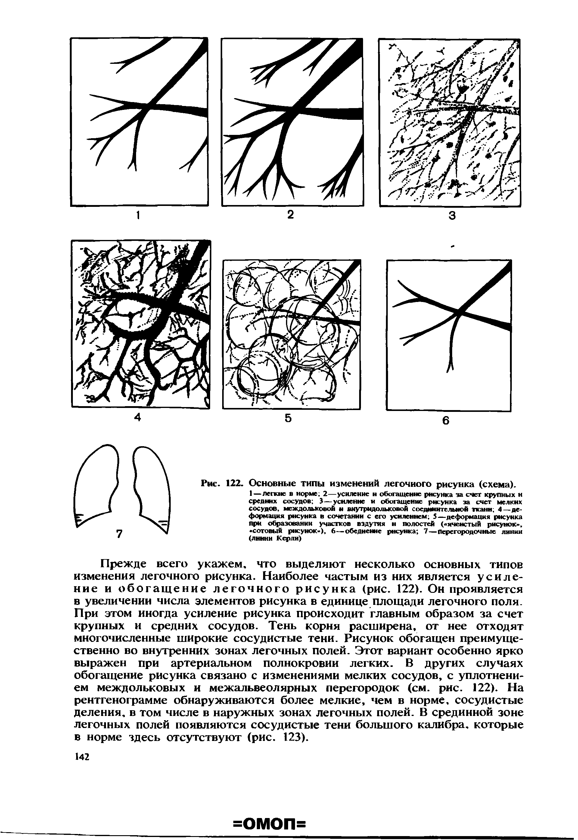 Рис. 122. Основные типы изменений легочного рисунка (схема).