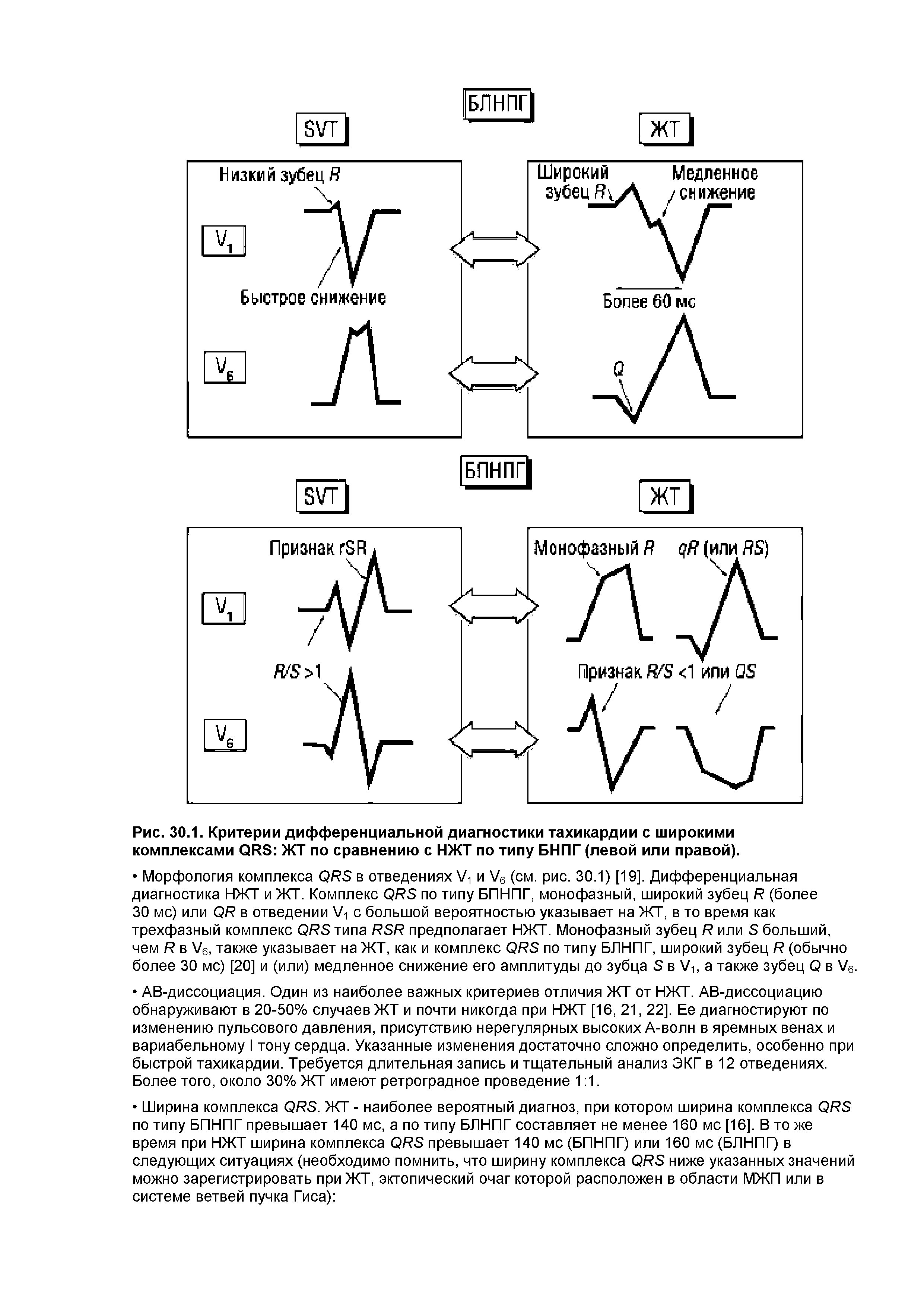 Рис. 30.1. Критерии дифференциальной диагностики тахикардии с широкими комплексами ОЙБ ЖТ по сравнению с НЖТ по типу БНПГ (левой или правой).