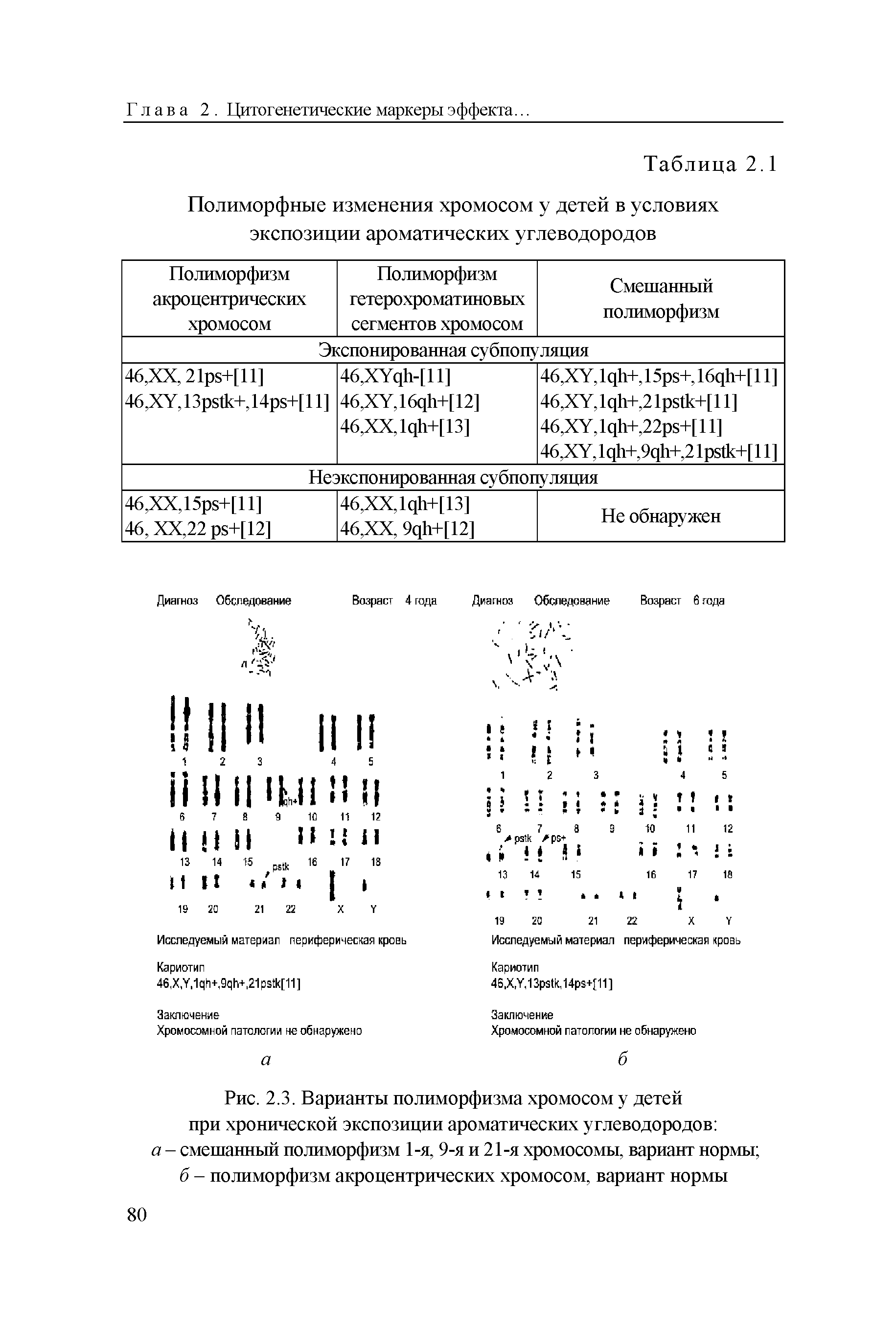 Рис. 2.3. Варианты полиморфизма хромосом у детей при хронической экспозиции ароматических углеводородов а - смешанный полиморфизм 1-я, 9-я и 21-я хромосомы, вариант нормы б - полиморфизм акроцентрических хромосом, вариант нормы...