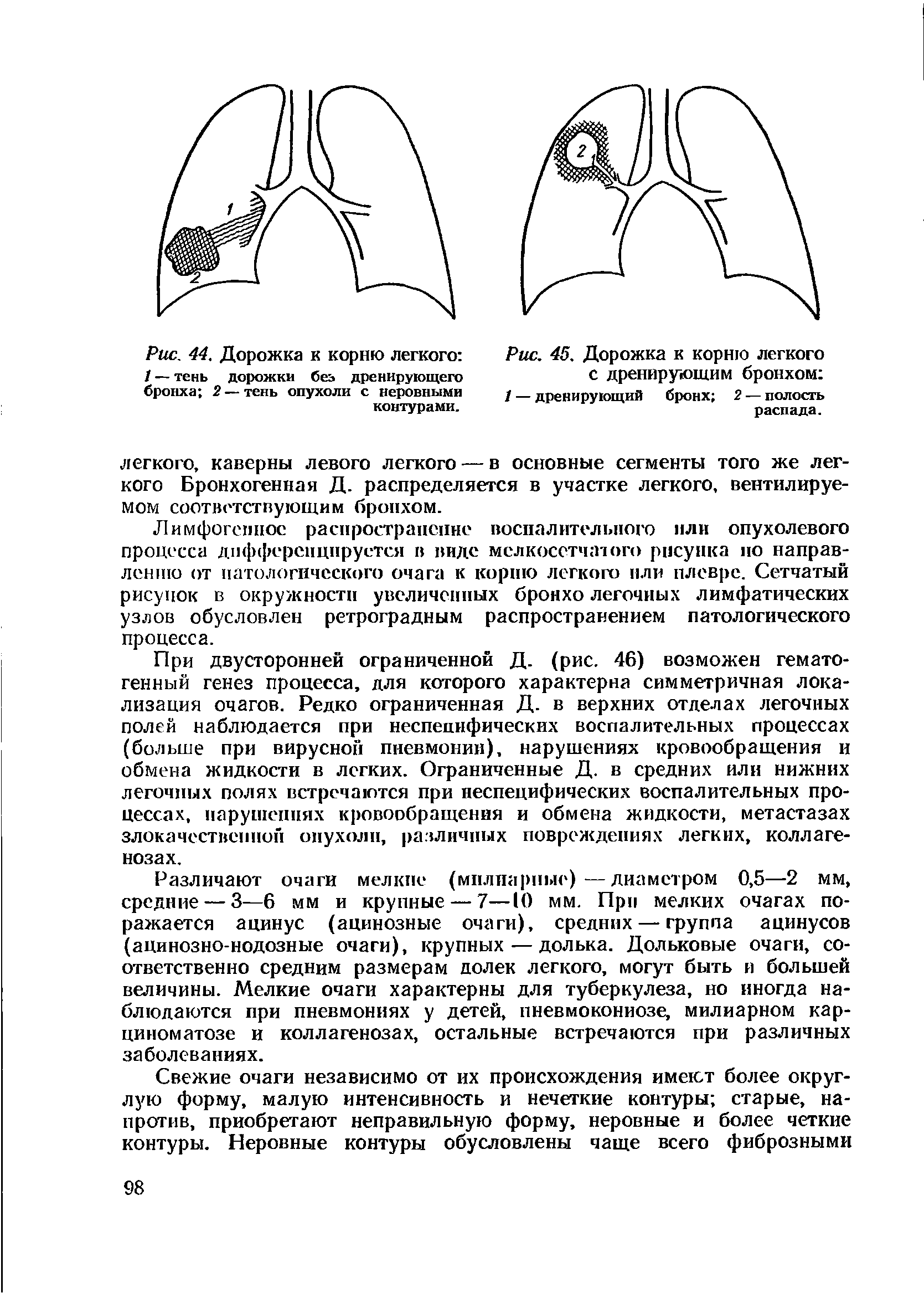 Рис. 45. Дорожка к корню легкого с дренирующим бронхом / — дренирующий бронх 2 — полость распада.