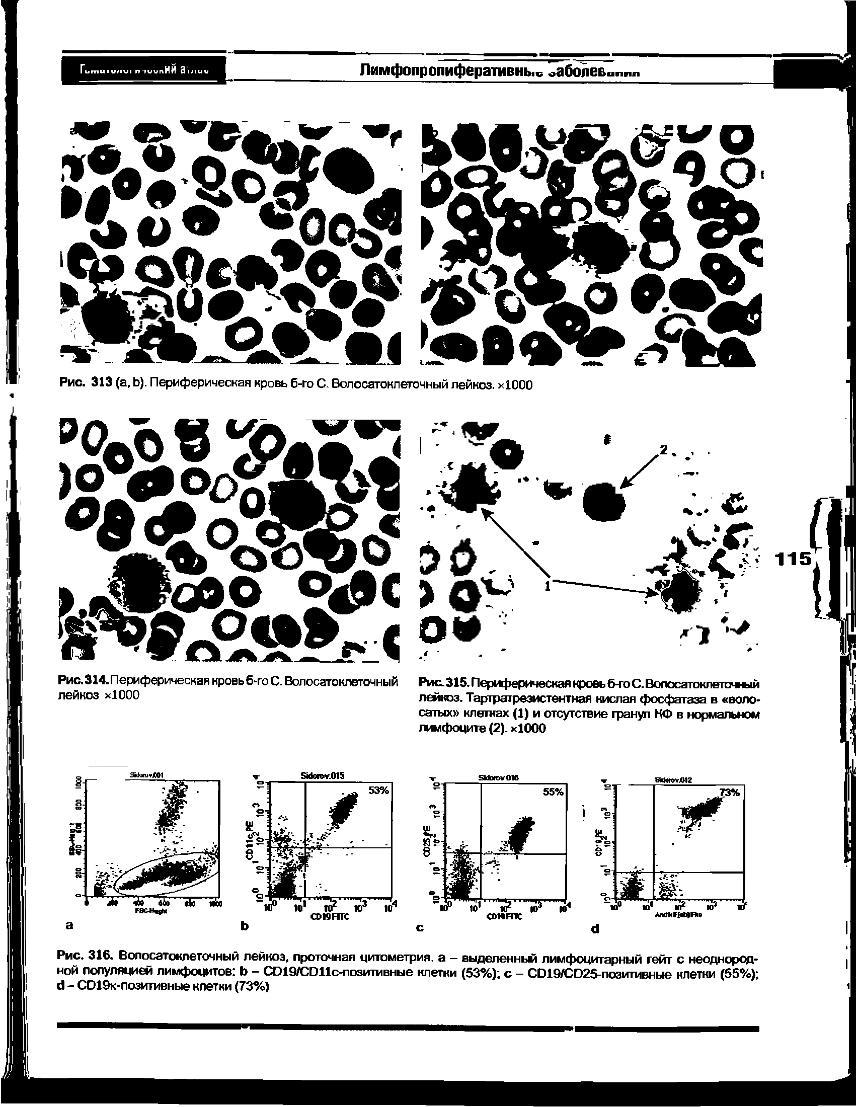 Рис. 316. Волосатокпеточный лейкоз, проточная цитометрия, а - выделенньм лимфоцитарный гейт с неоднородной популяцией лимфоцитов Ь - СОЮ/СОИс-позитавные клетки (53%) с - С019/С025-позитивные клетки (55%) <1 - СО19к-лозигивные клетки (73%)...