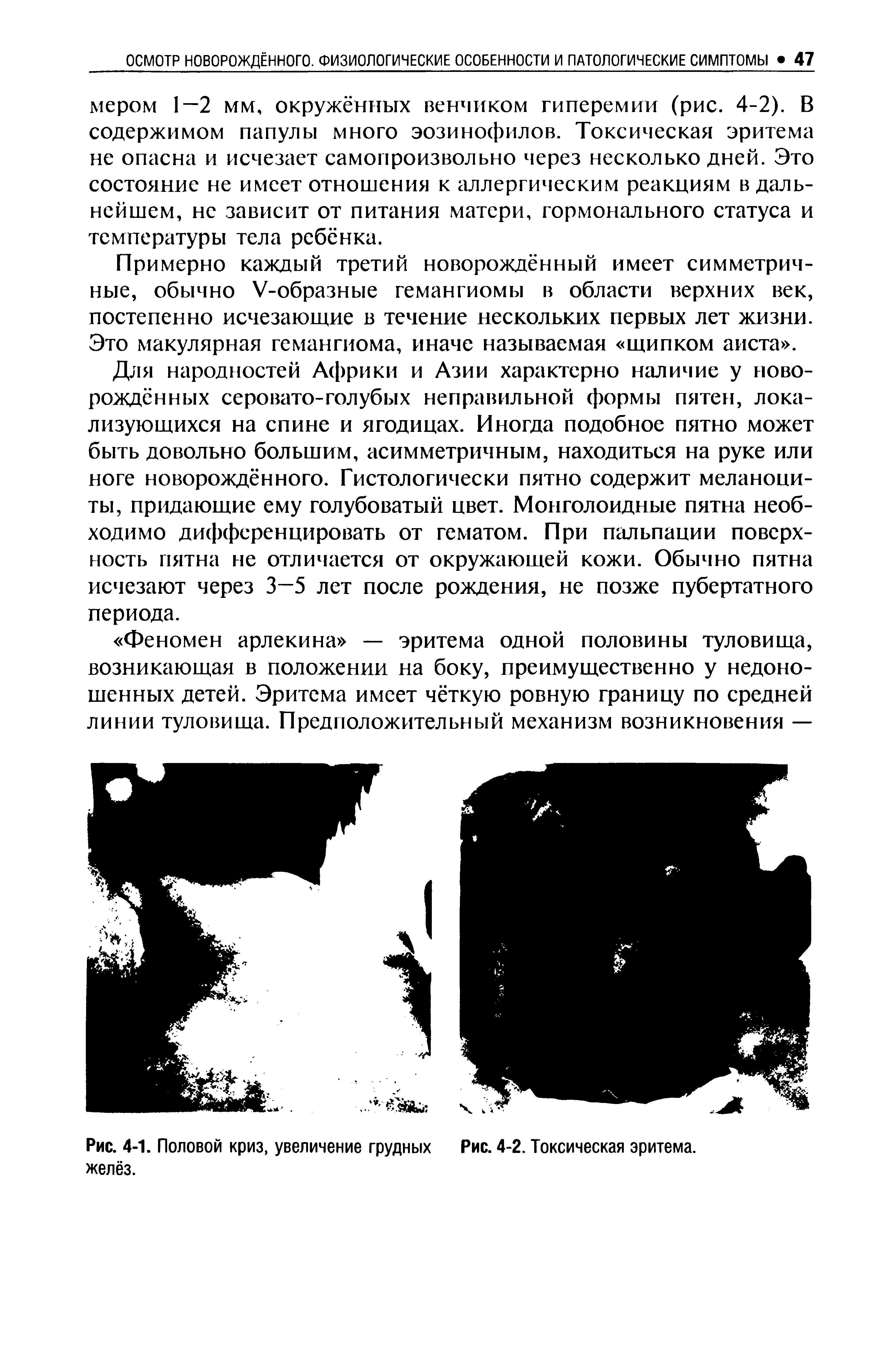 Рис. 4-1. Половой криз, увеличение грудных Рис. 4-2. Токсическая эритема, желёз.