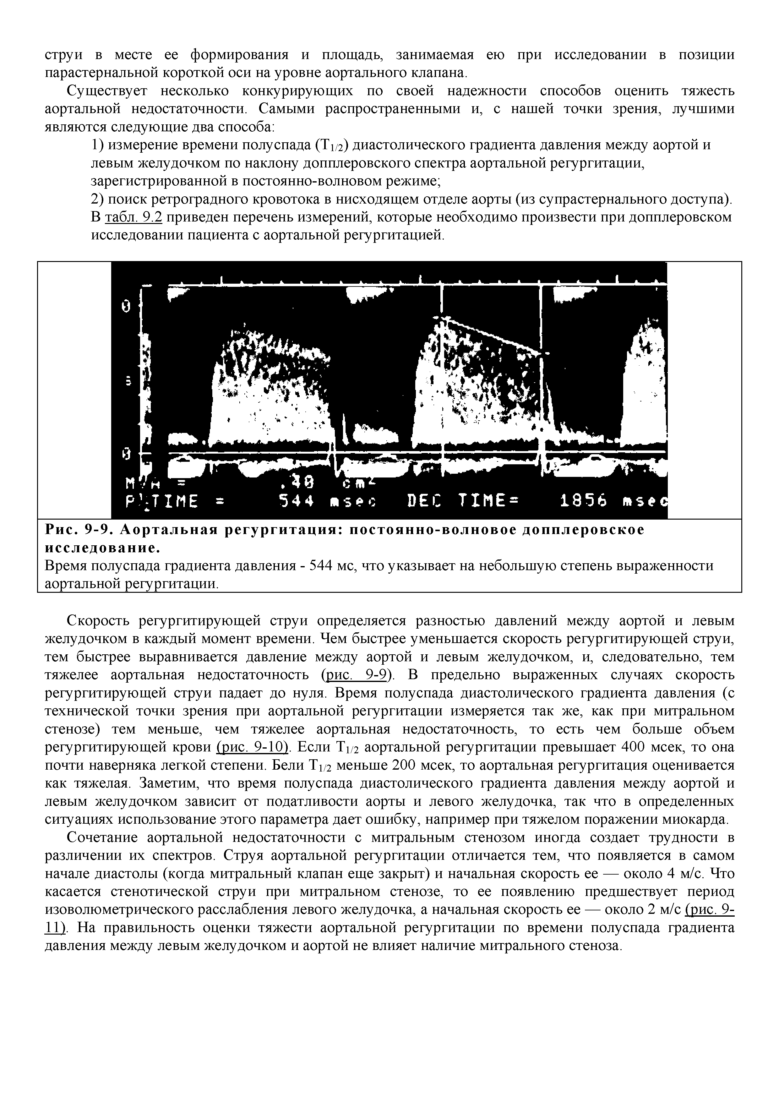 Рис. 9-9. Аортальная регургитация постоянно-волновое допплеровское исследование.