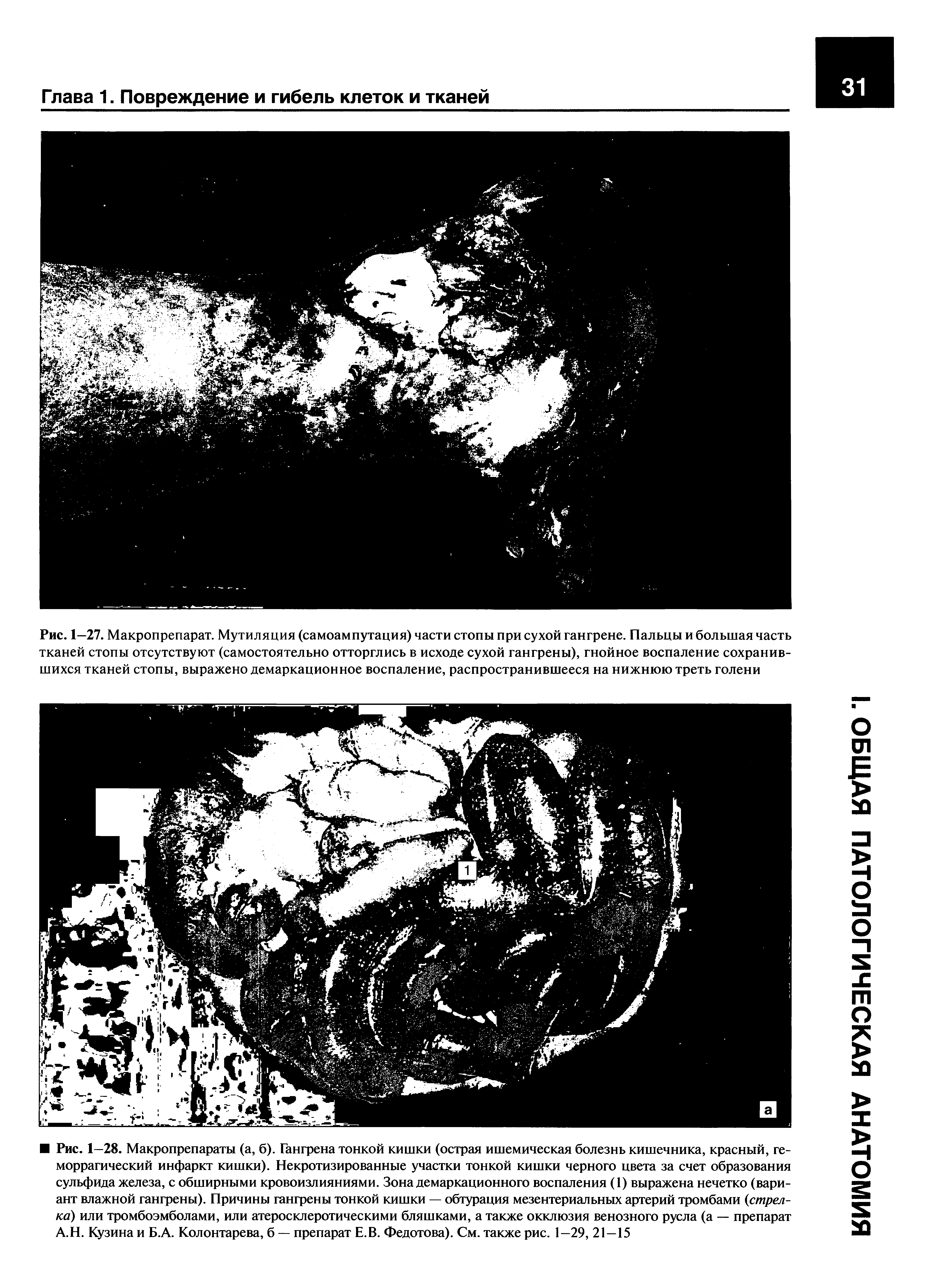 Рис. 1—27. Макропрепарат. Мутиляция (самоампутация) части стопы при сухой гангрене. Пальцы и большая часть тканей стопы отсутствуют (самостоятельно отторглись в исходе сухой гангрены), гнойное воспаление сохранившихся тканей стопы, выражено демаркационное воспаление, распространившееся на нижнюю треть голени...