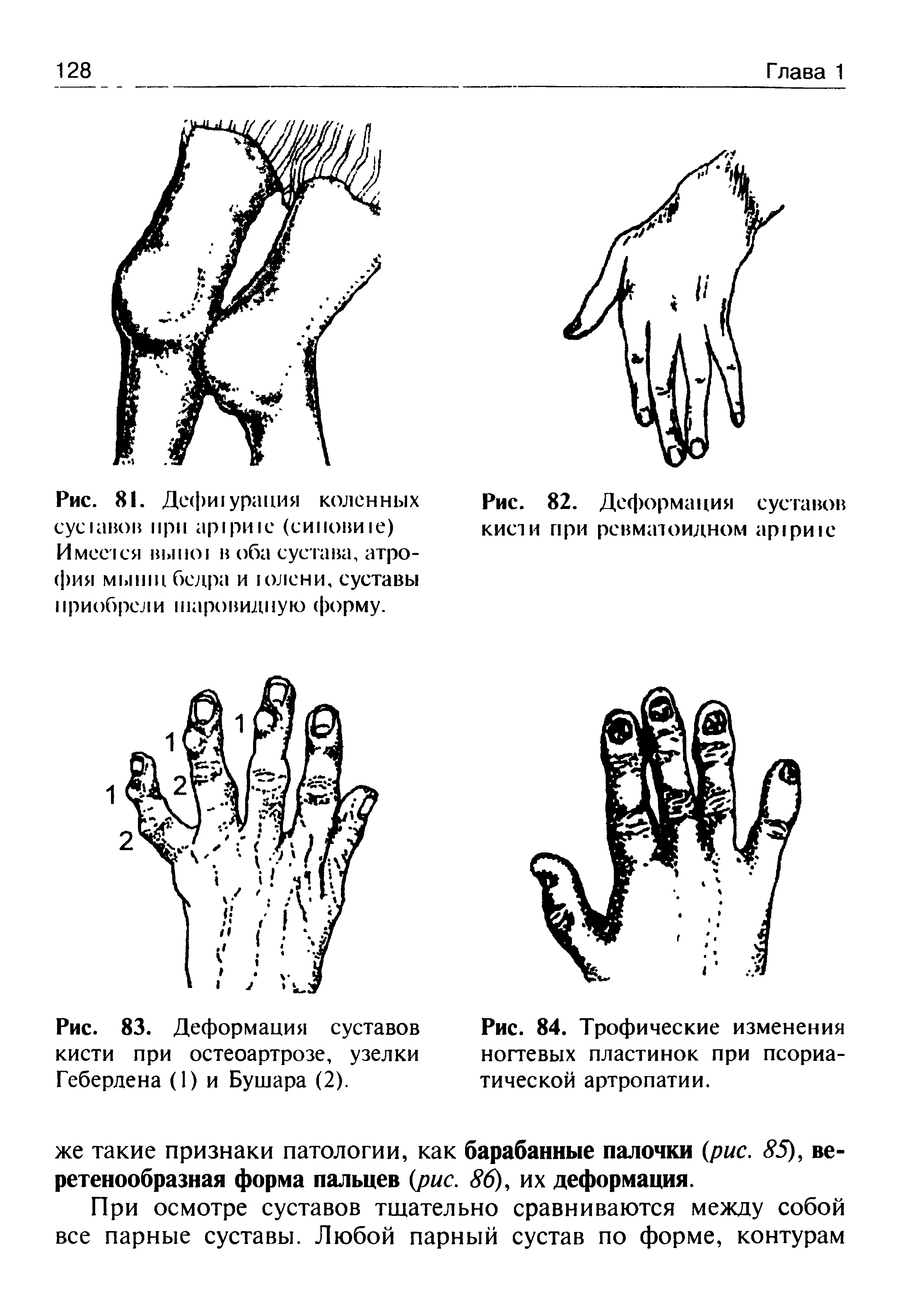 Рис. 84. Трофические изменения ногтевых пластинок при псориатической артропатии.